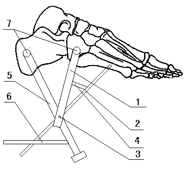 Calcaneus pre-operation returning frame