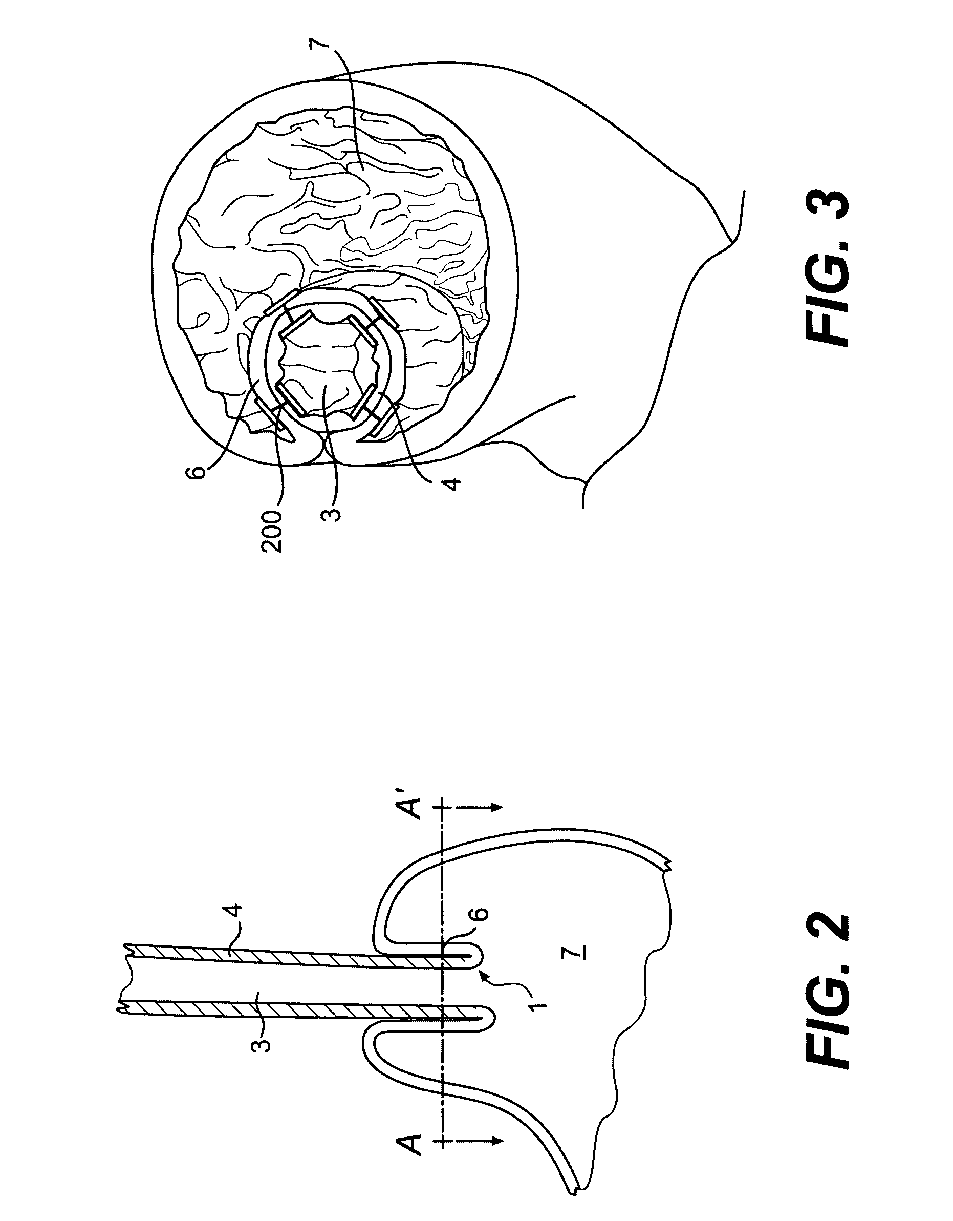 Devices and methods for fastening tissue layers