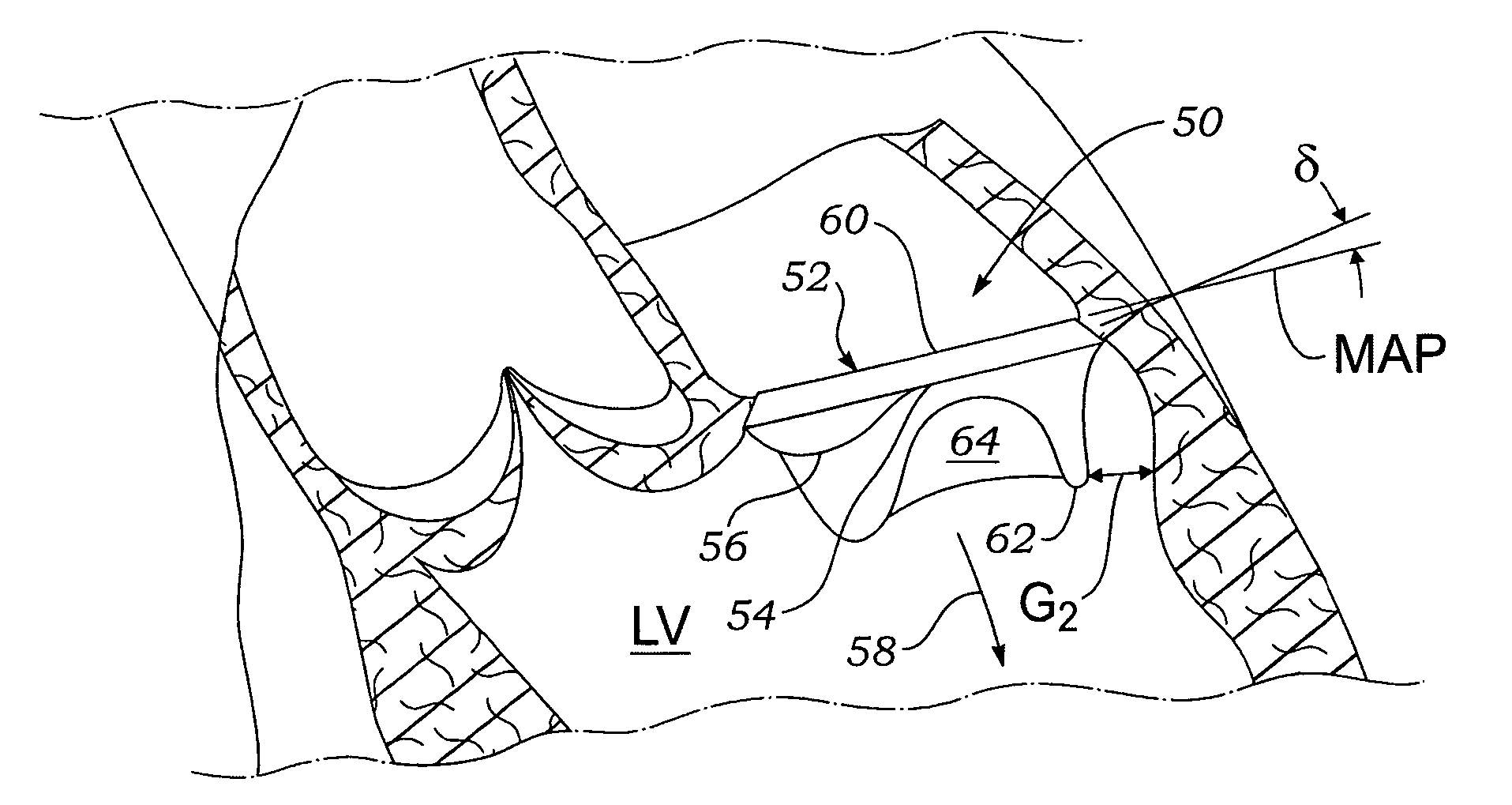 Methods of implanting a prosthetic mitral heart valve having a contoured sewing ring