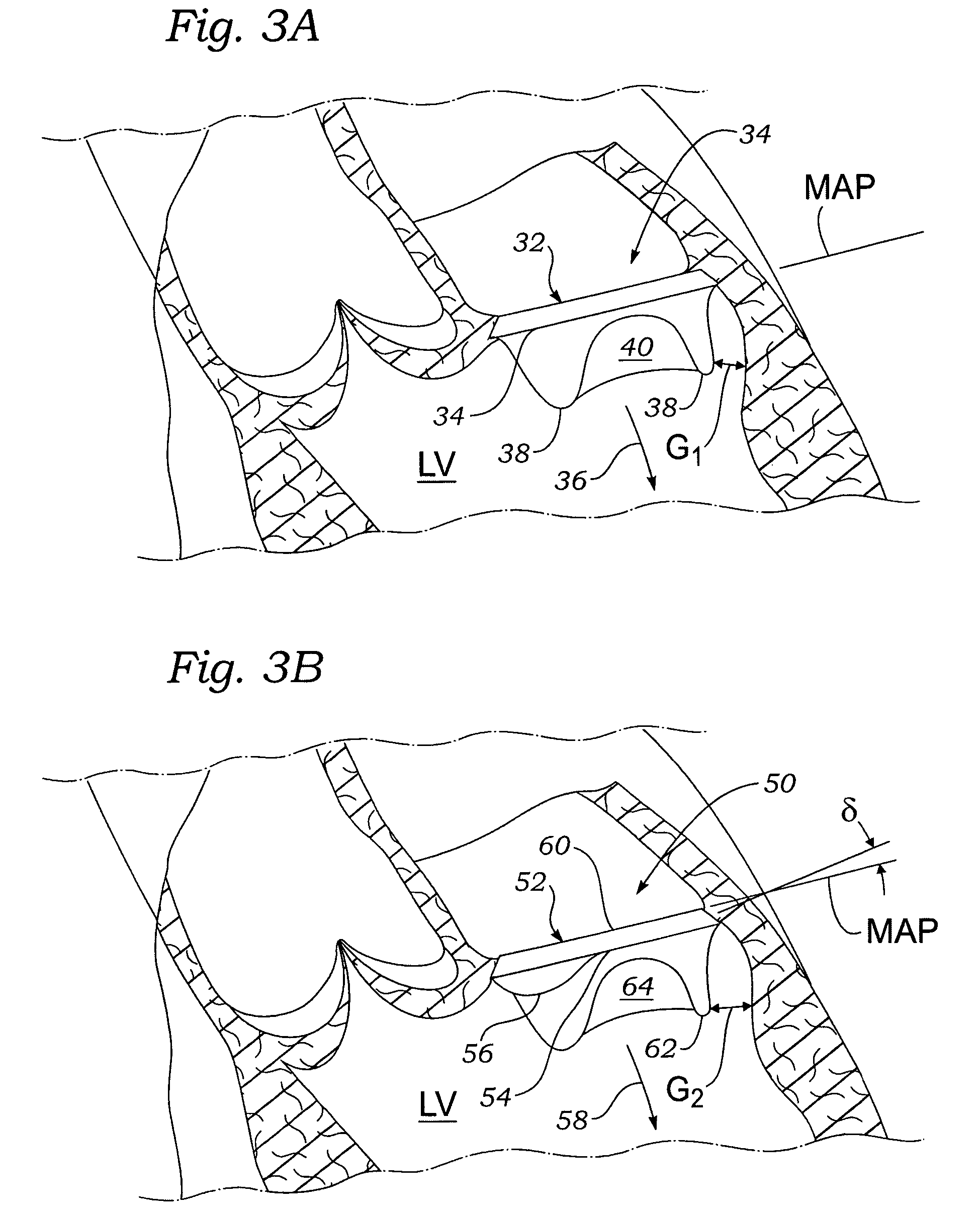 Methods of implanting a prosthetic mitral heart valve having a contoured sewing ring