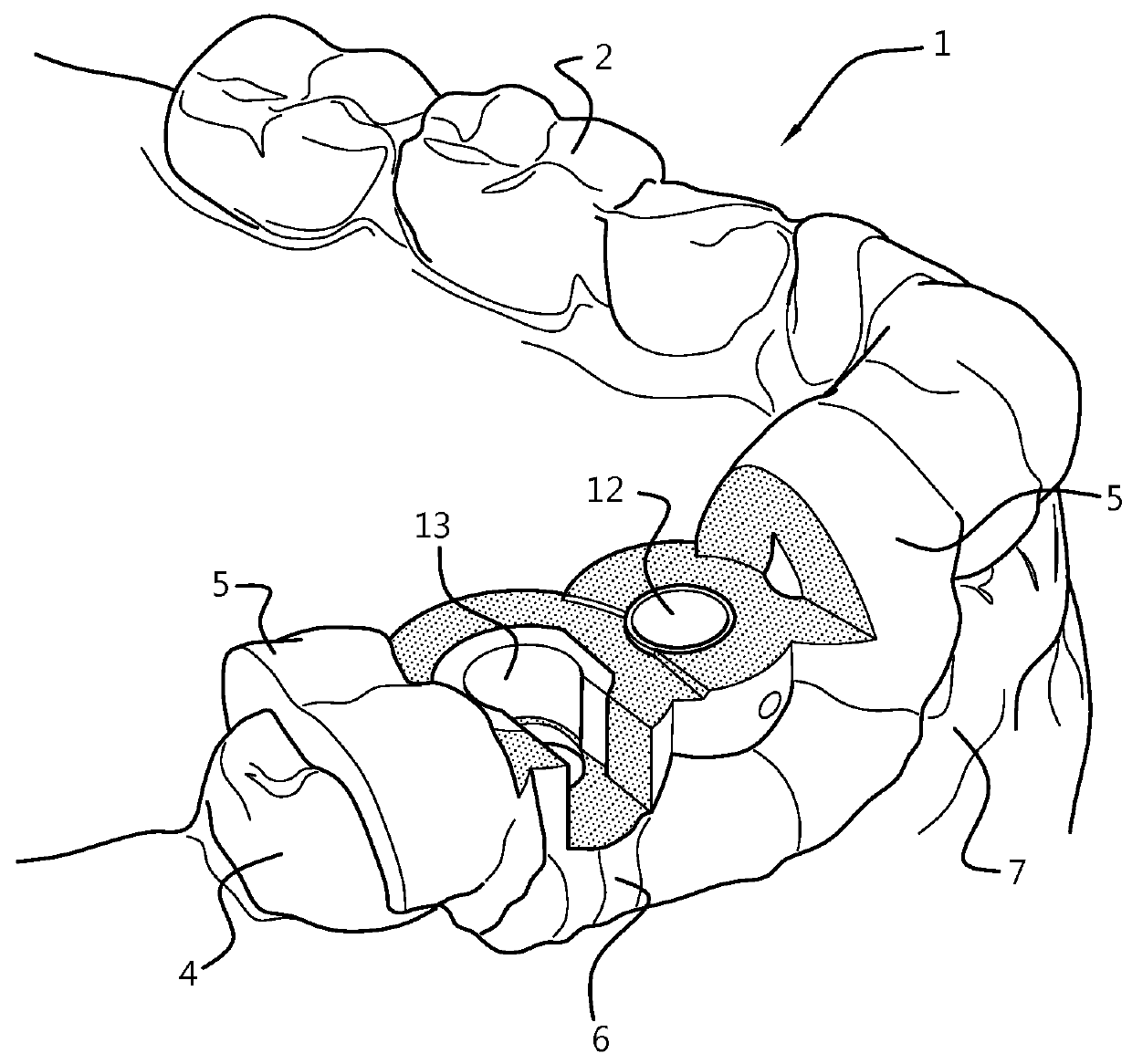 Force-closure or form-closure positioning of surgical templates for guided implant dentistry