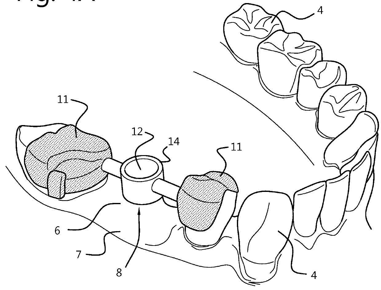 Force-closure or form-closure positioning of surgical templates for guided implant dentistry