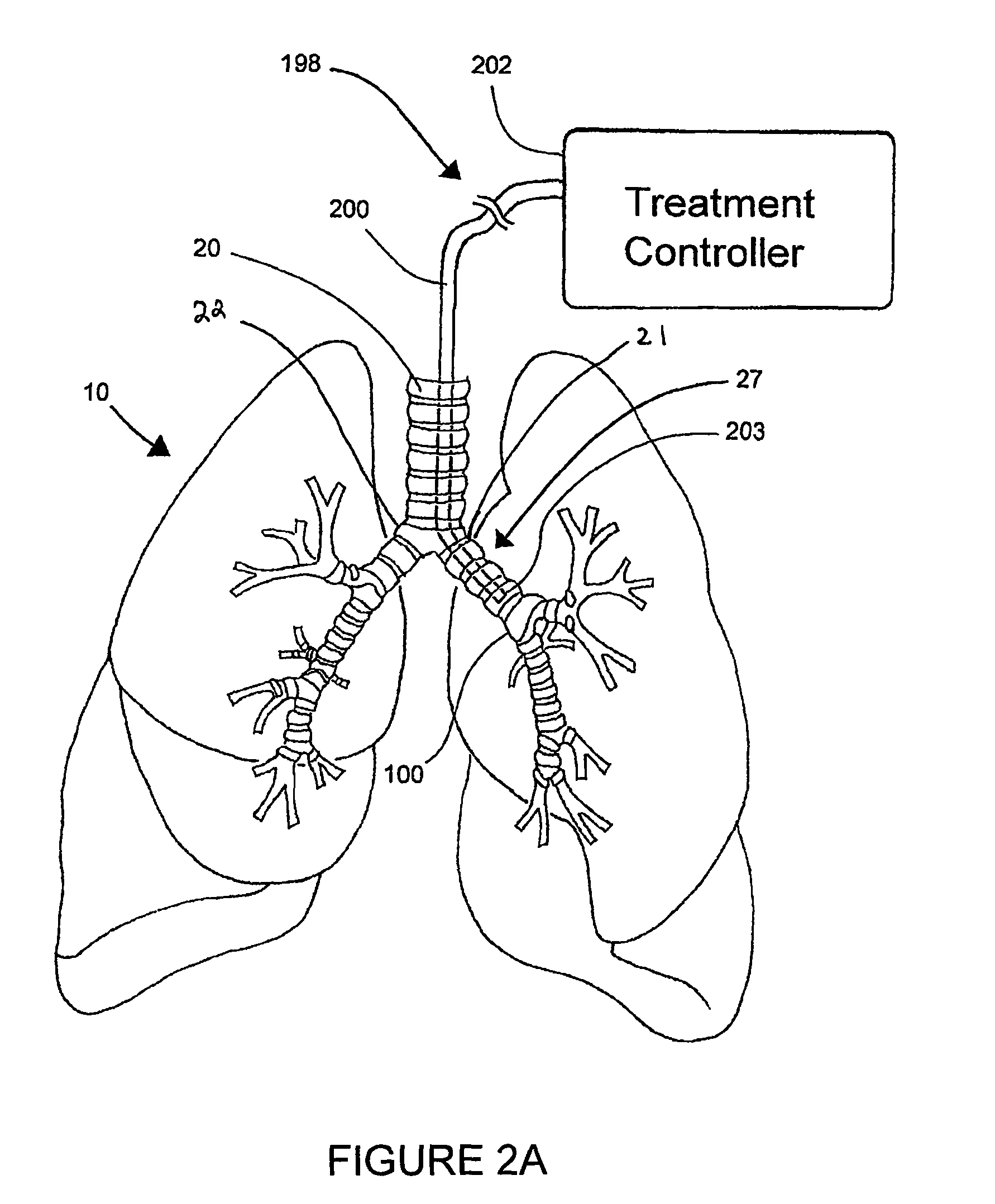 Systems, assemblies, and methods for treating a bronchial tree