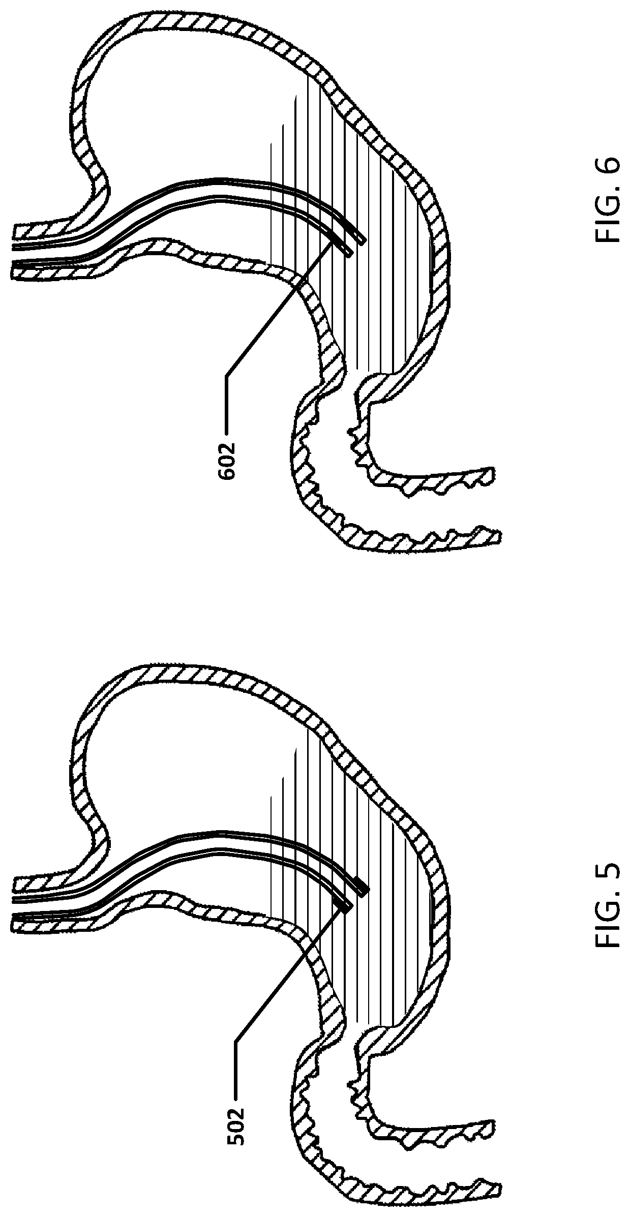 Devices and methods to measure gastric residual volume