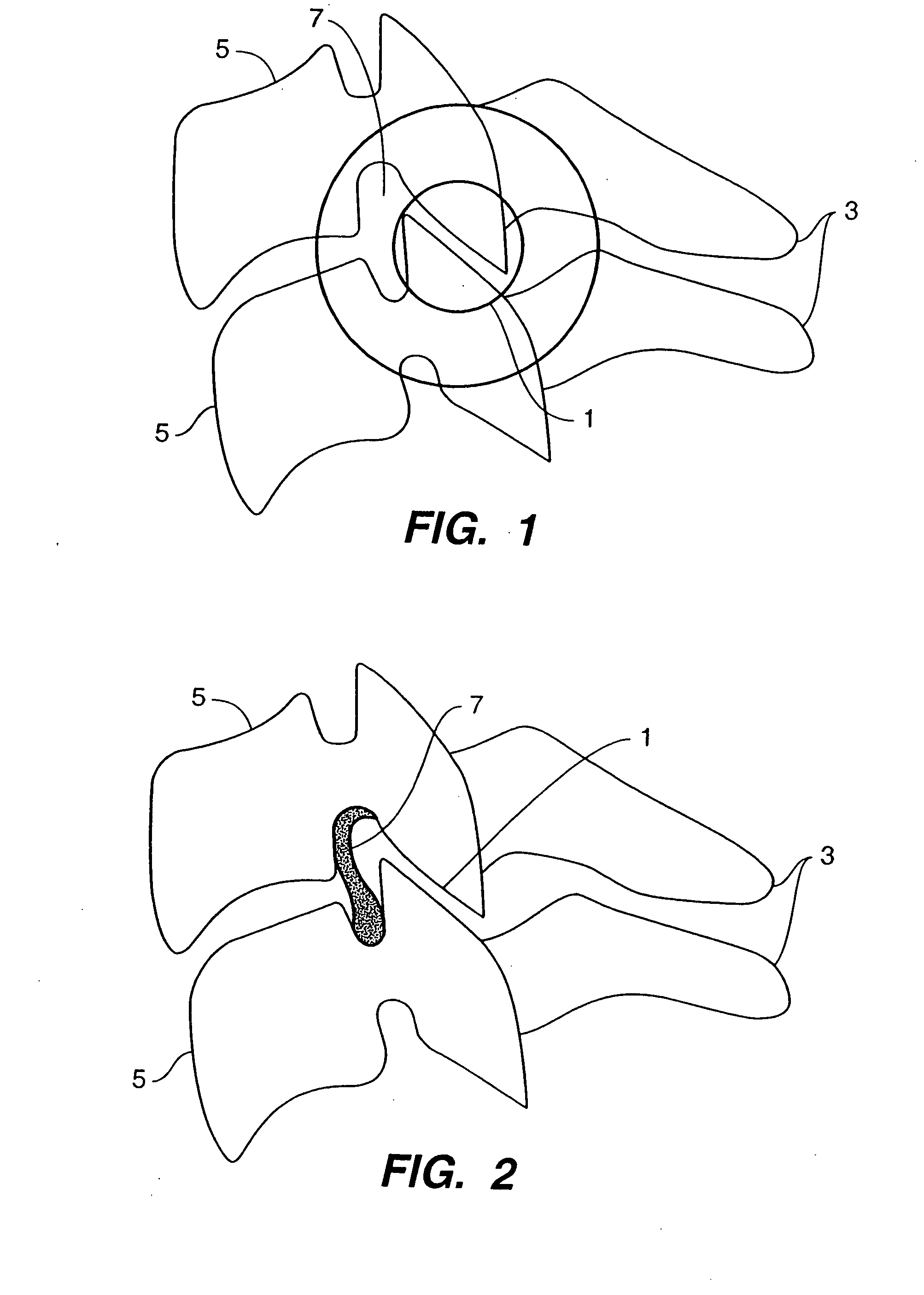 Inter-cervical facet implant with implantation tool