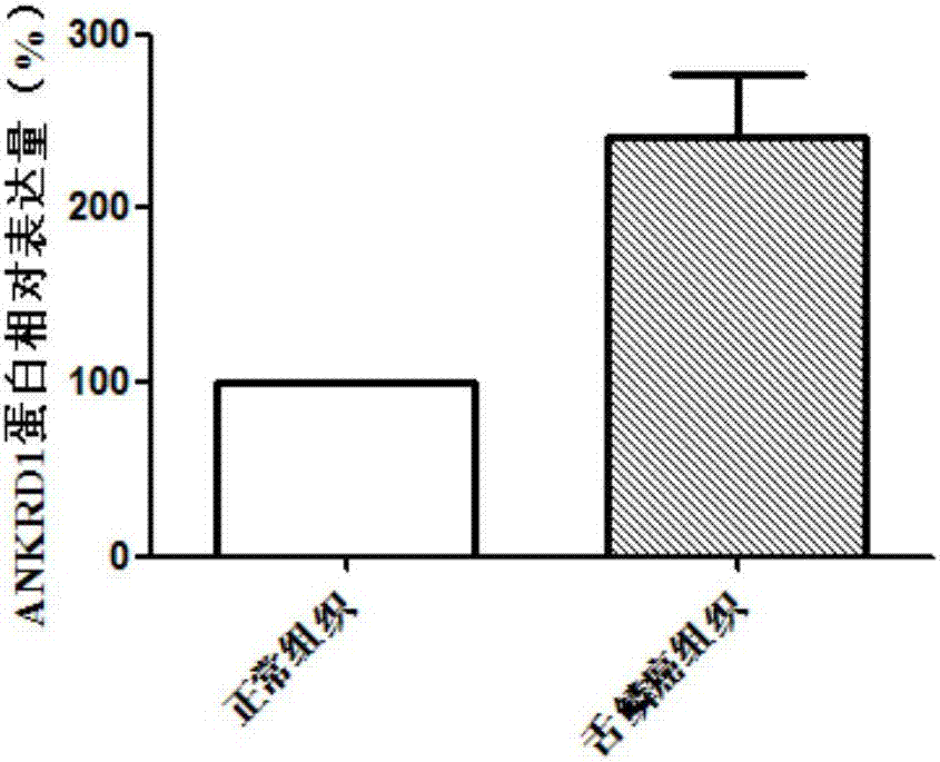 ANKRD1 as diagnosis and treatment target of tongue squamous cell carcinoma