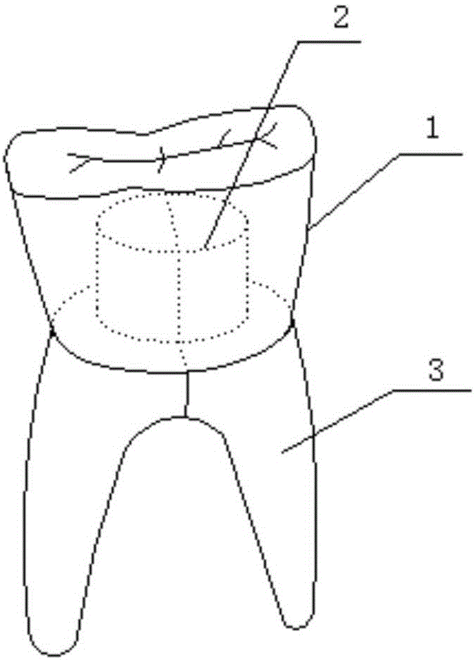 Personalized assembly type dental implant and implant tooth