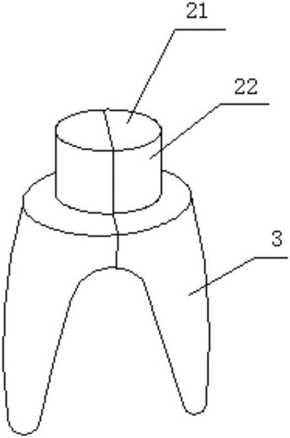 Personalized assembly type dental implant and implant tooth