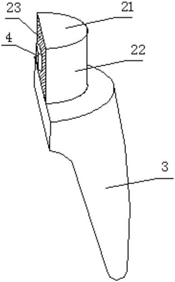 Personalized assembly type dental implant and implant tooth