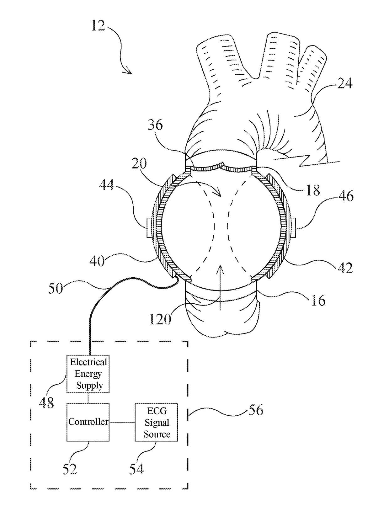 Artificial Ventricles