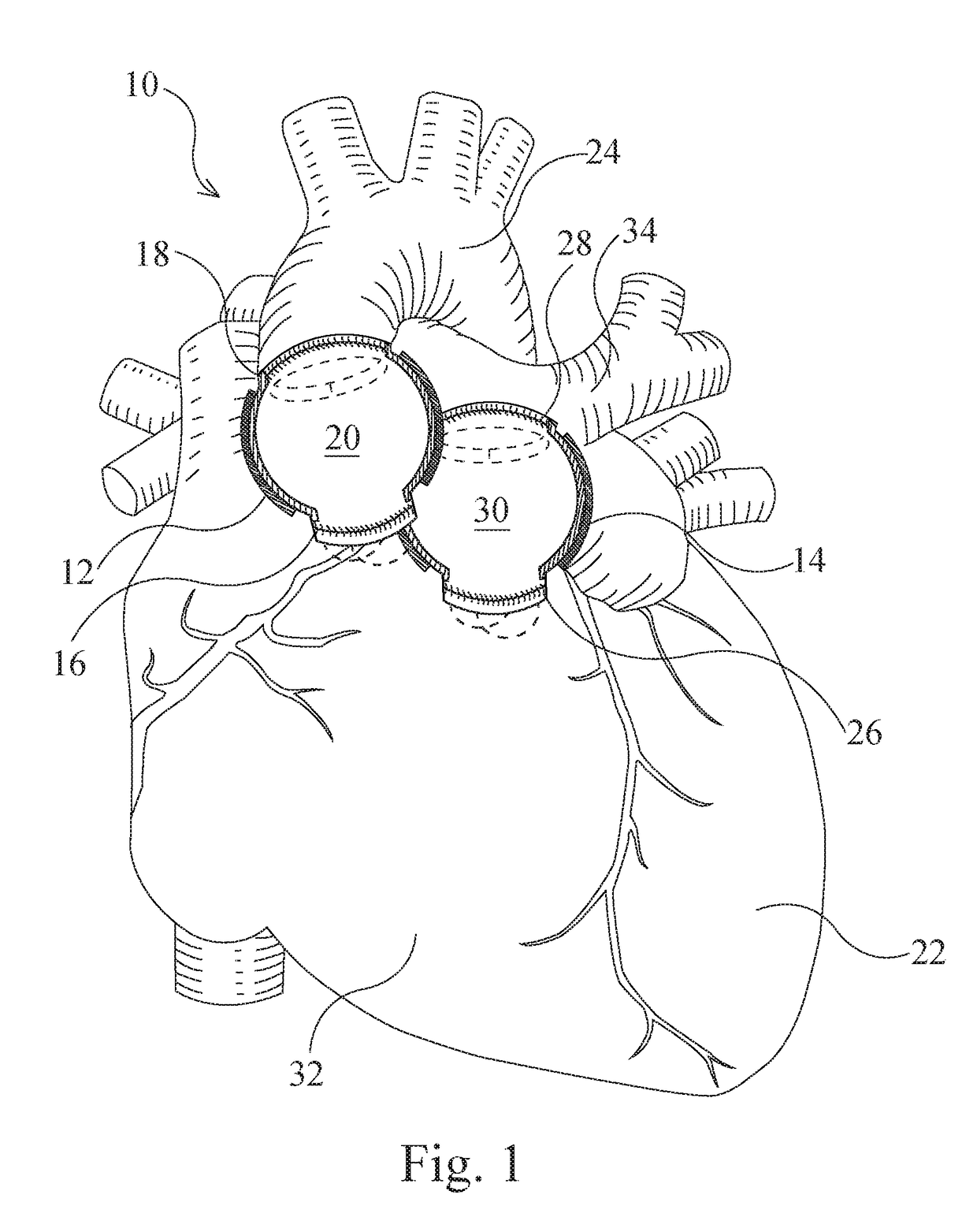 Artificial Ventricles