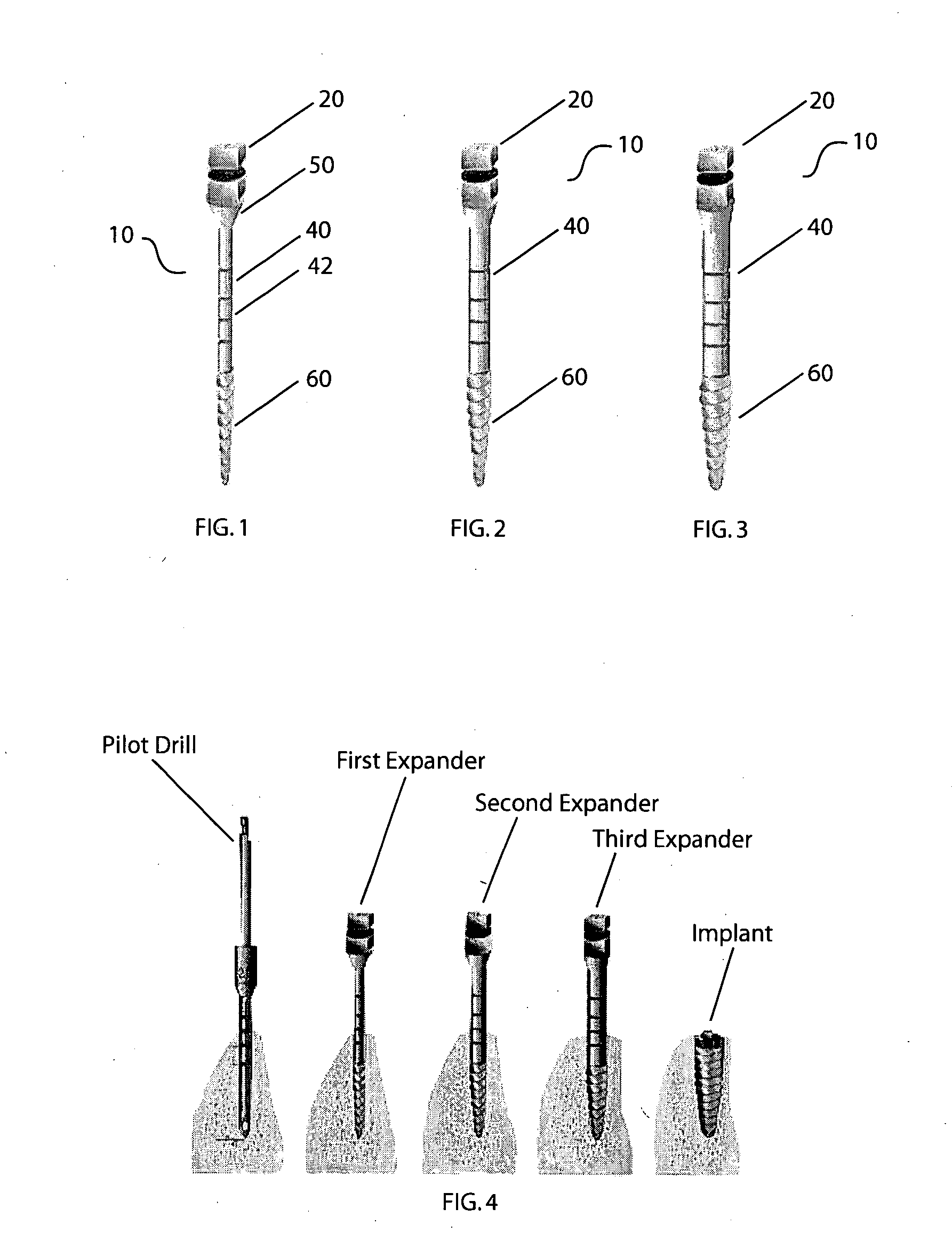 Method of bone expansion and compression for receiving a dental implant using threaded expanders