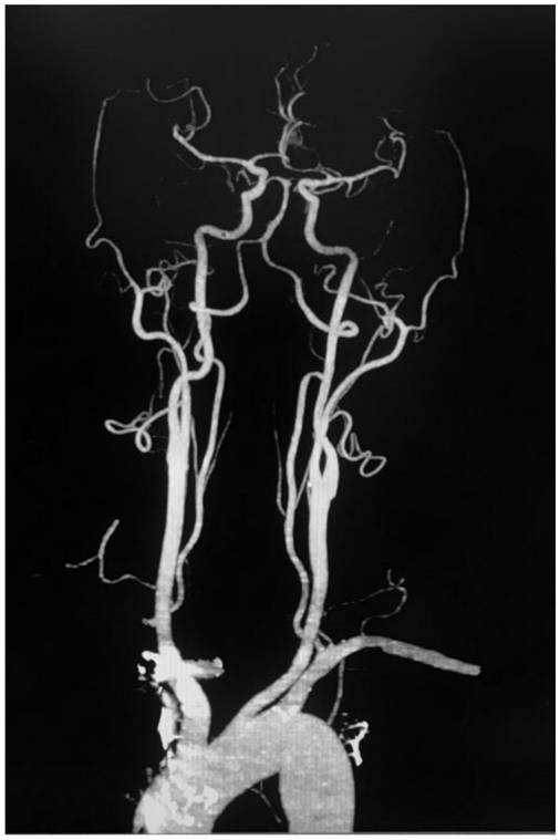 Head and neck angiography method