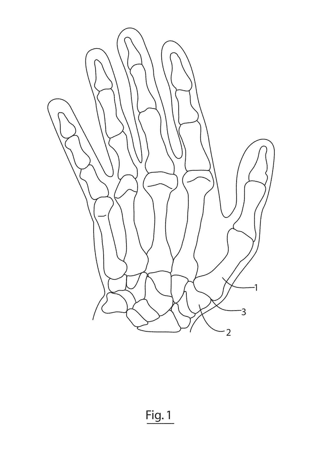 Implant for a bone joint