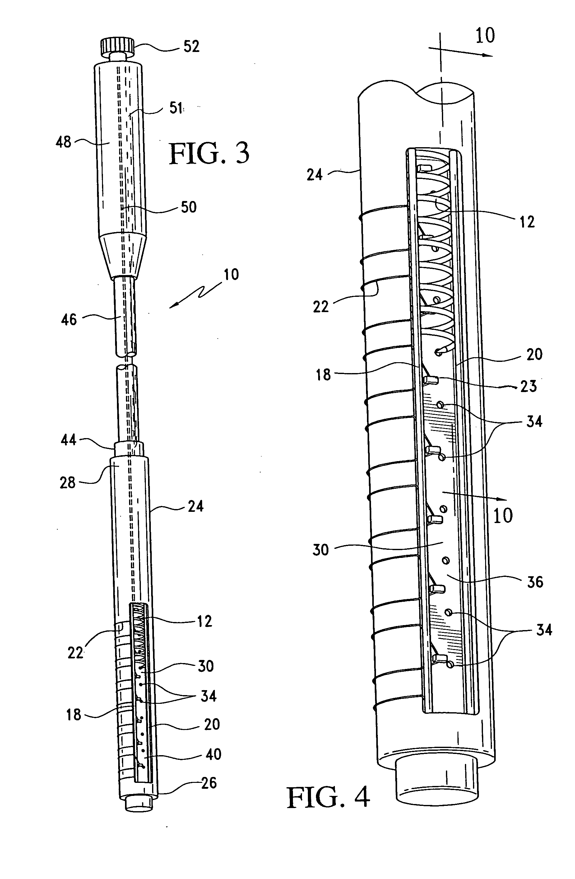 Single pass gastric restriction with a corkscrew style wall anchor