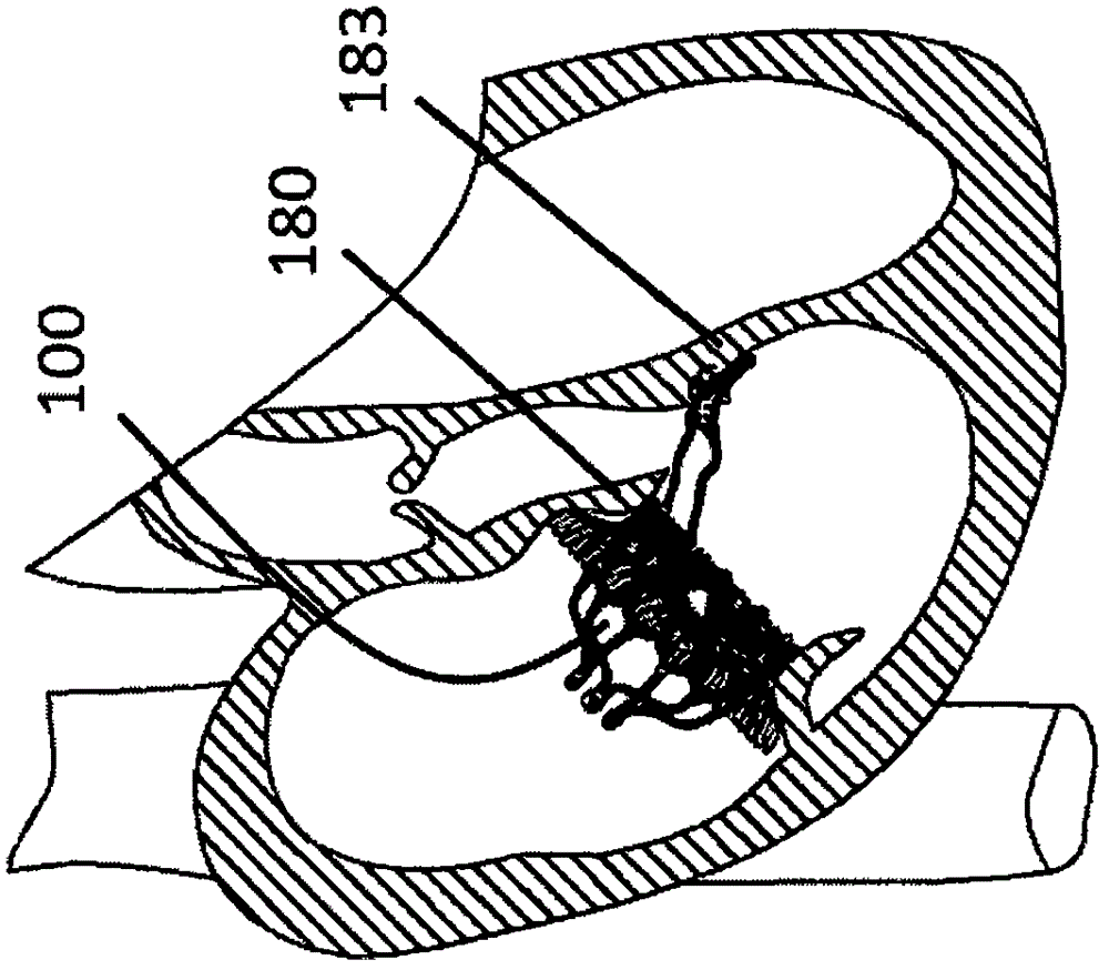 Self-adaptive cardiac valve prosthesis