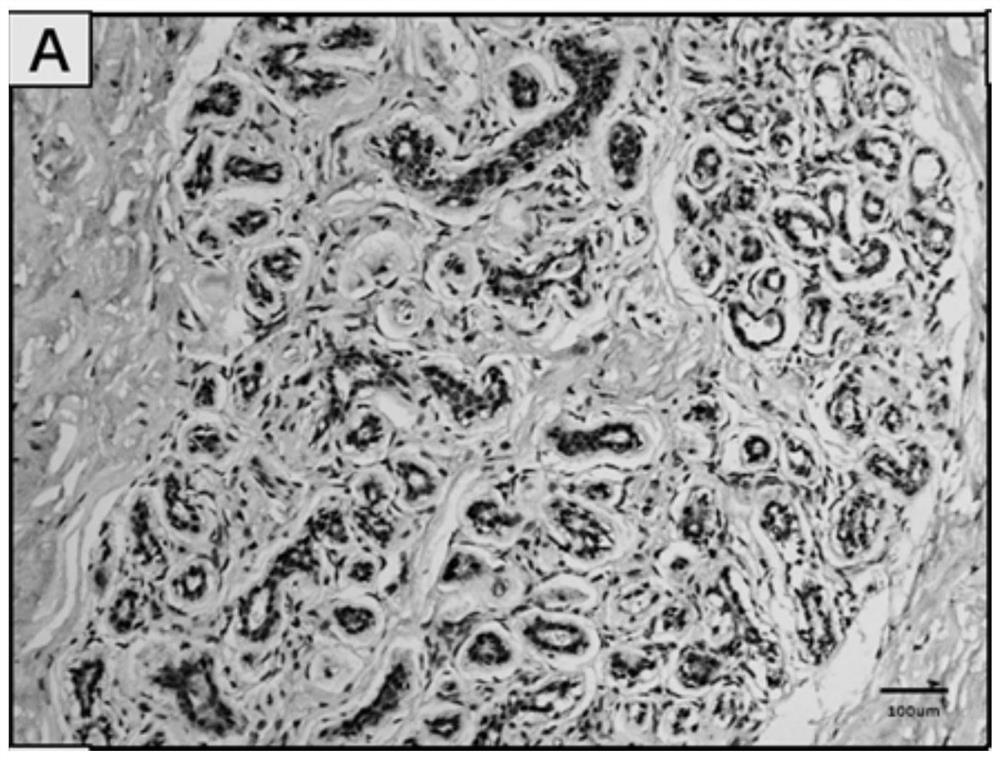 Application of kdm6b protein in breast cancer prognosis assessment kit and diagnostic kit