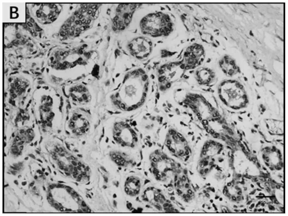 Application of kdm6b protein in breast cancer prognosis assessment kit and diagnostic kit