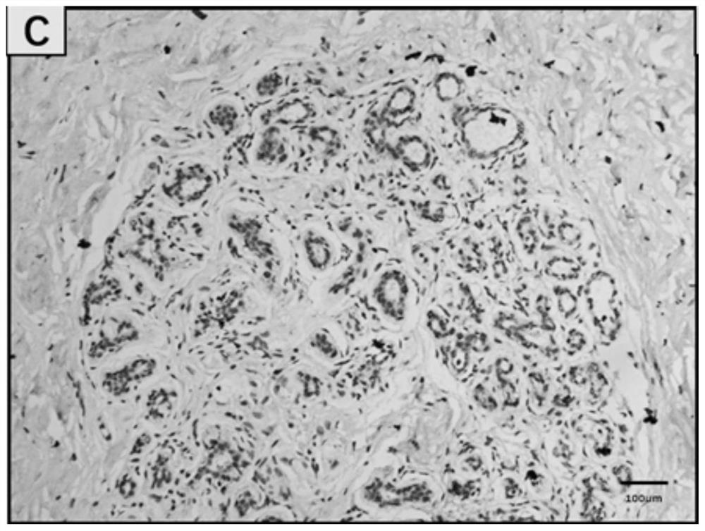 Application of kdm6b protein in breast cancer prognosis assessment kit and diagnostic kit