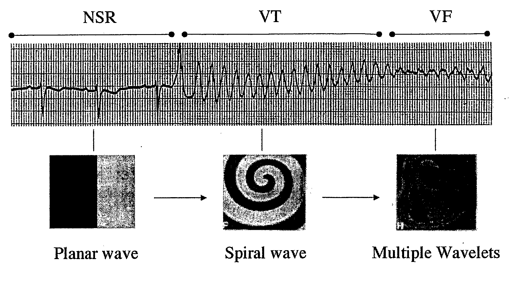 Method of Identifying Strategies for Treatment or Prevention of Ventricular Fibrillation and Ventricular Tachycardia