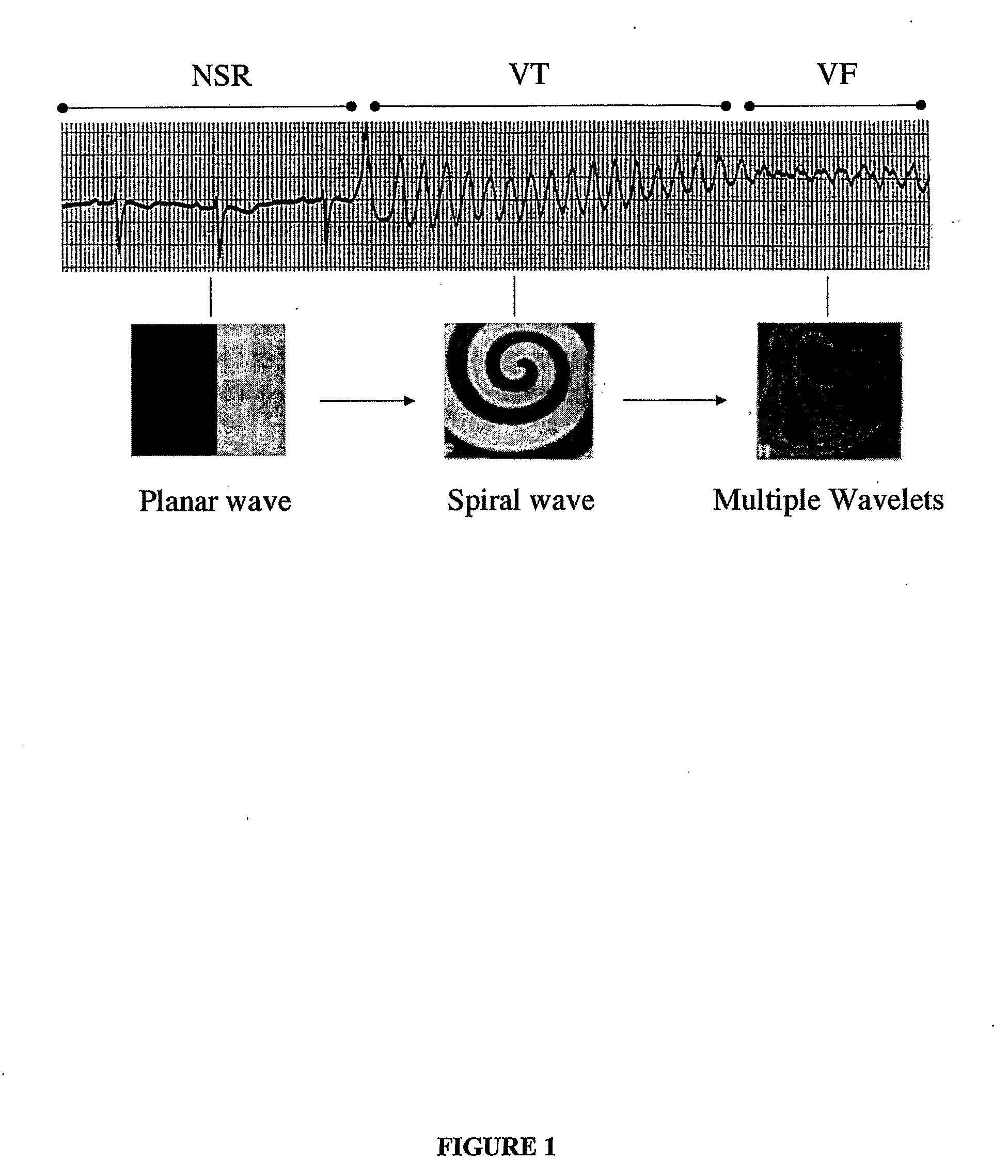 Method of Identifying Strategies for Treatment or Prevention of Ventricular Fibrillation and Ventricular Tachycardia