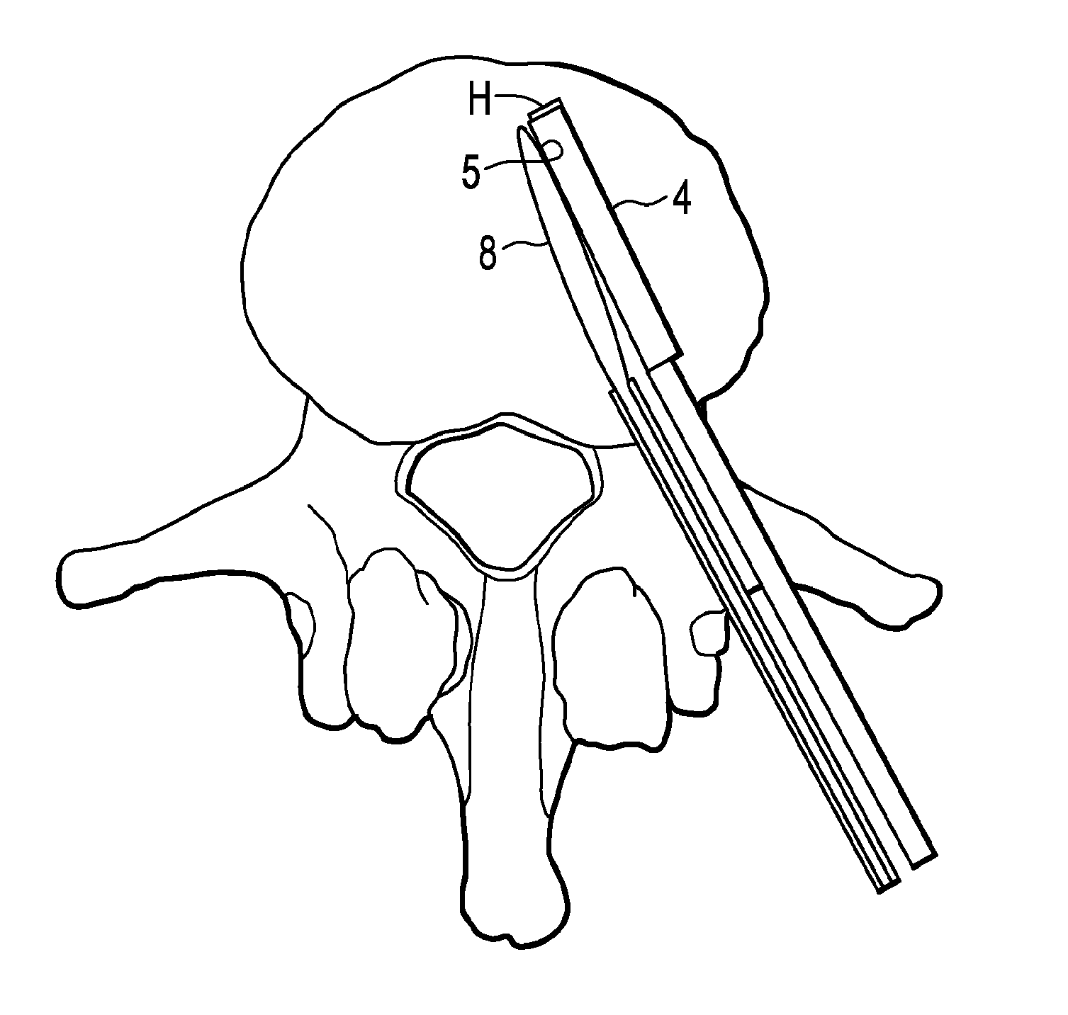 Balloon With Shape Control For Spinal Procedures