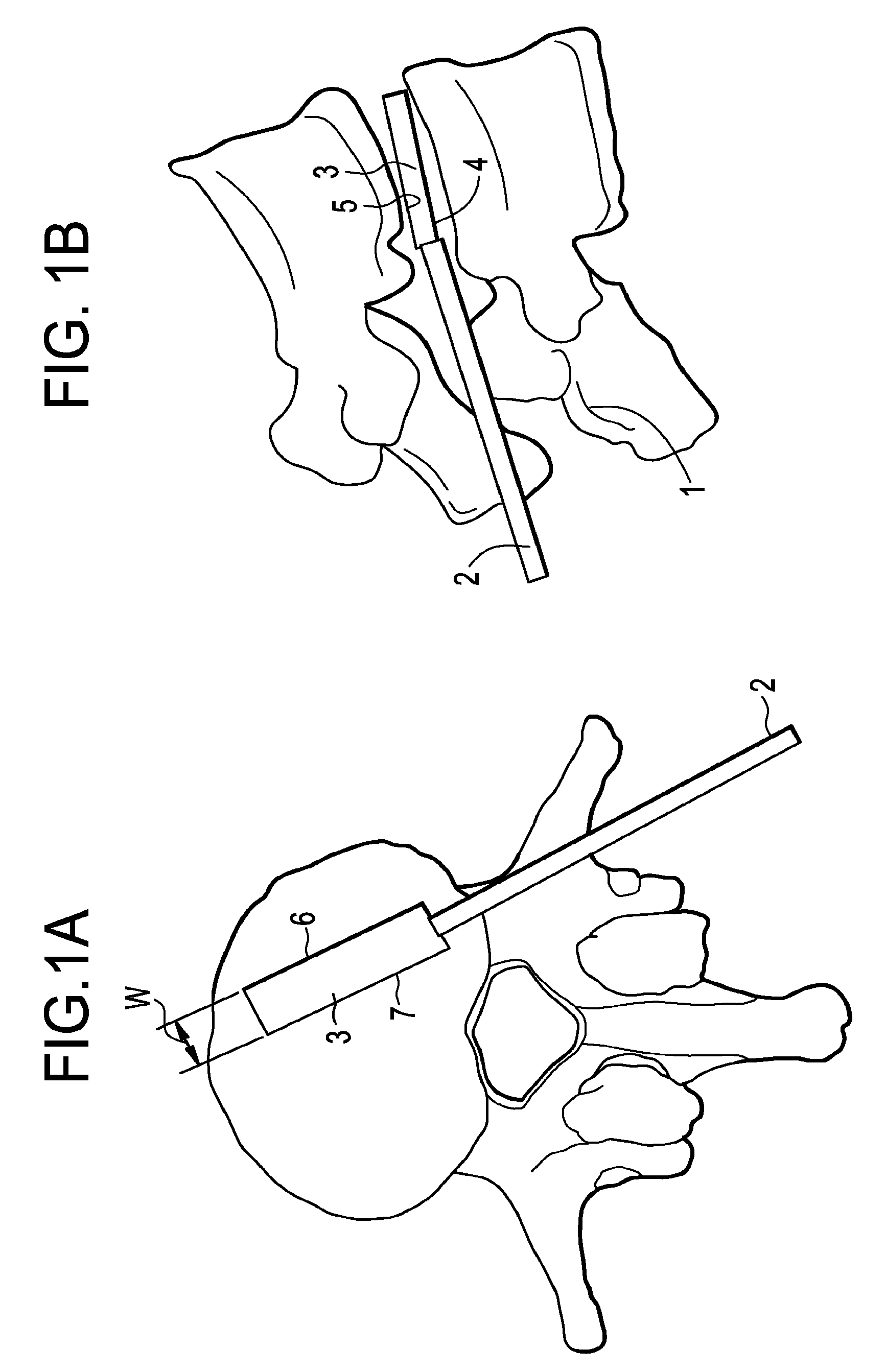 Balloon With Shape Control For Spinal Procedures