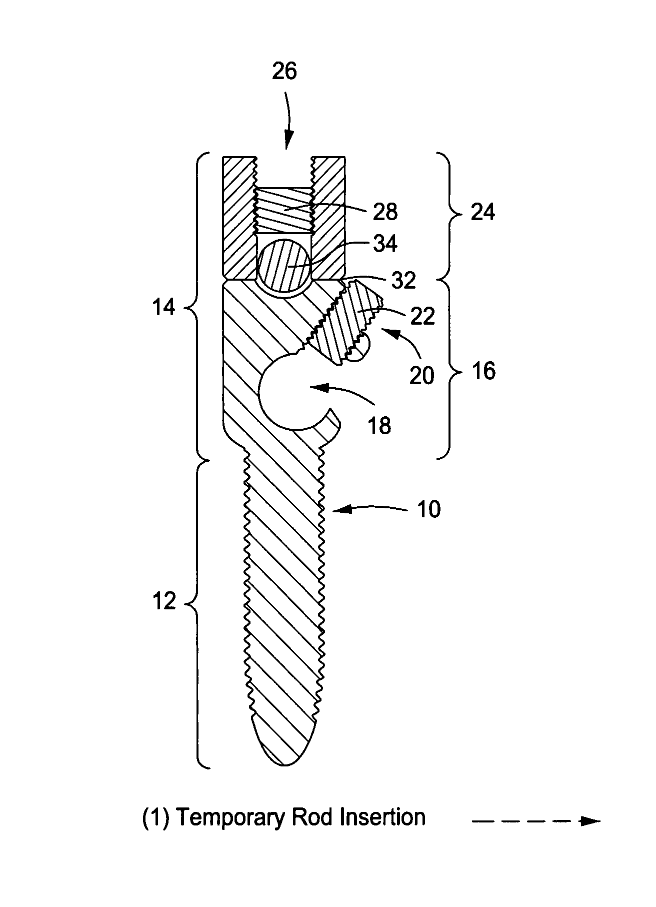 Pedicle screw