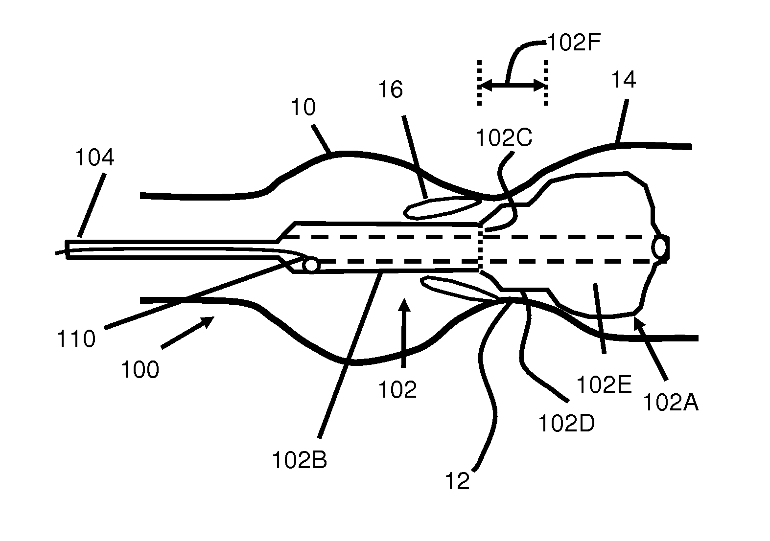 Positionable Valvuloplasty Catheter