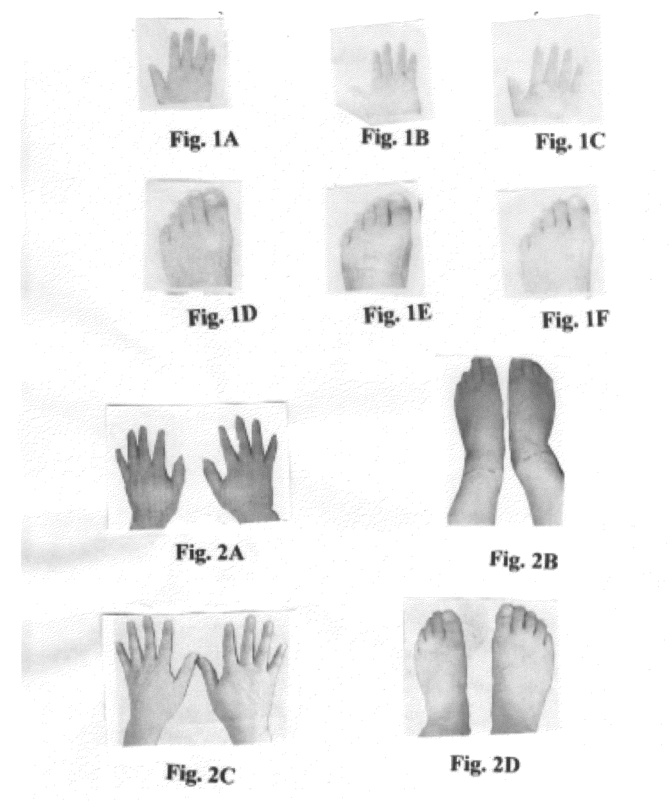 Method of treating diabetic peripheral neuropathy through amendment of pre-neuronal diabetic coagulative micro-angiopathy and neuronal deficiency of mitochondrial ATP production, and through induction of neuronal regeneration