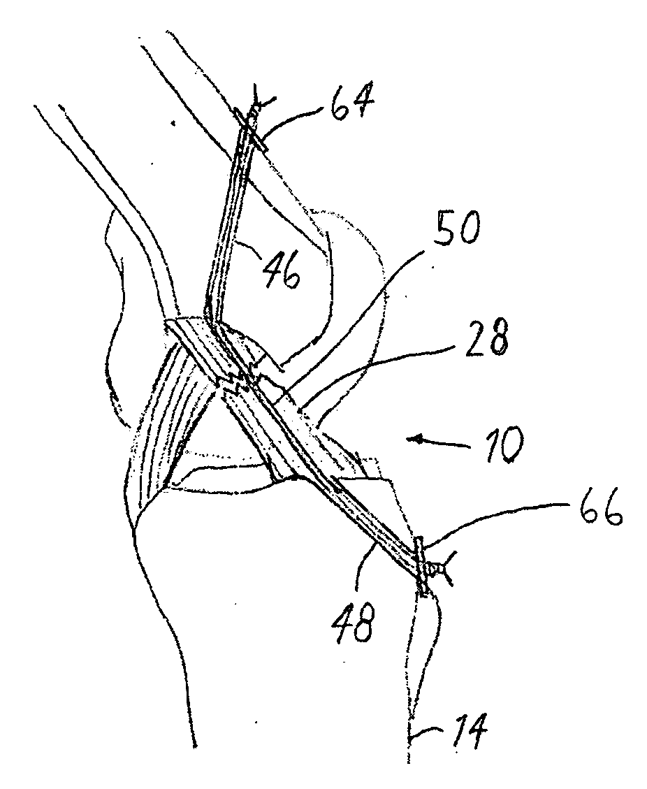 Anterior cruciate ligament tether