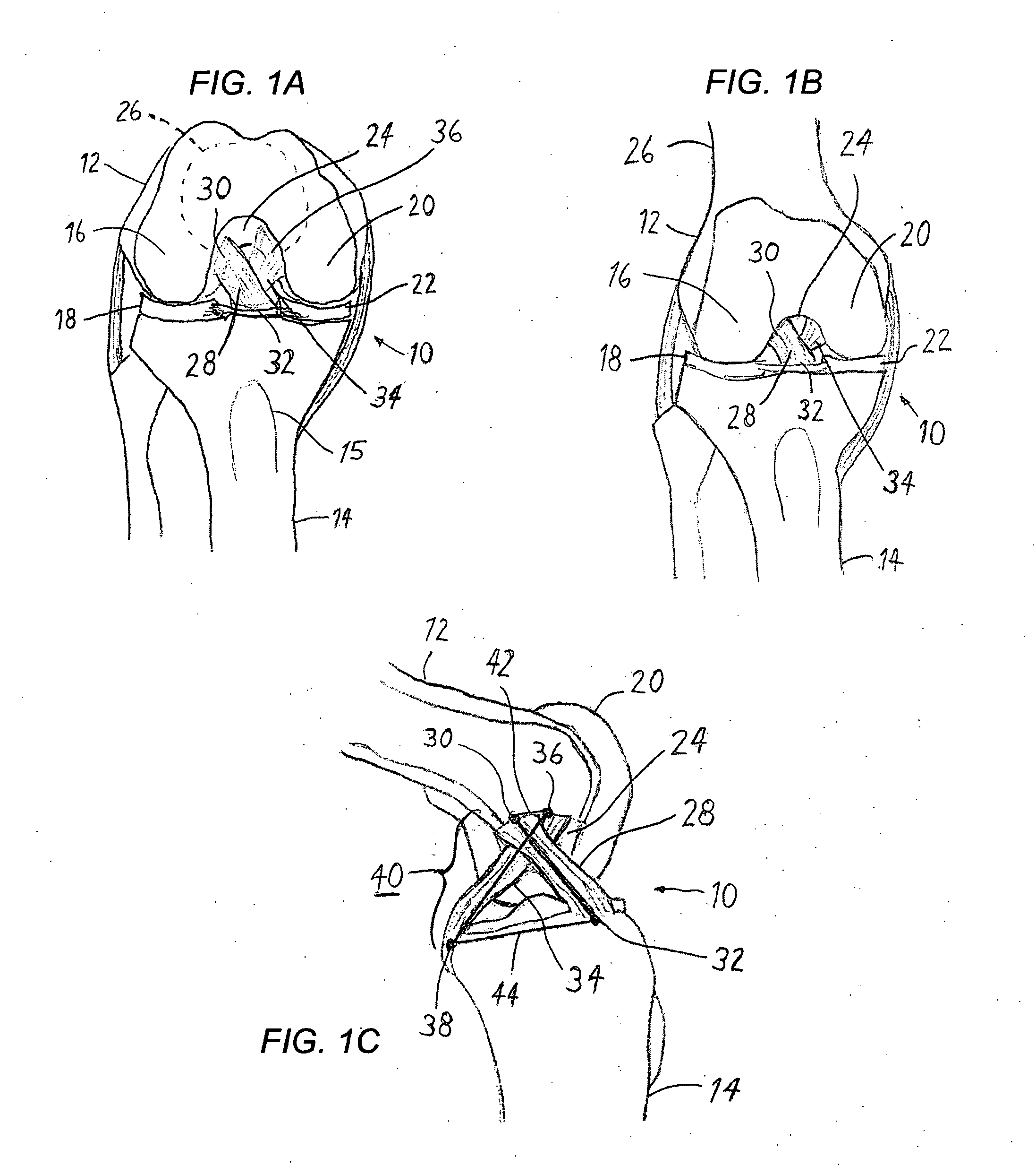 Anterior cruciate ligament tether