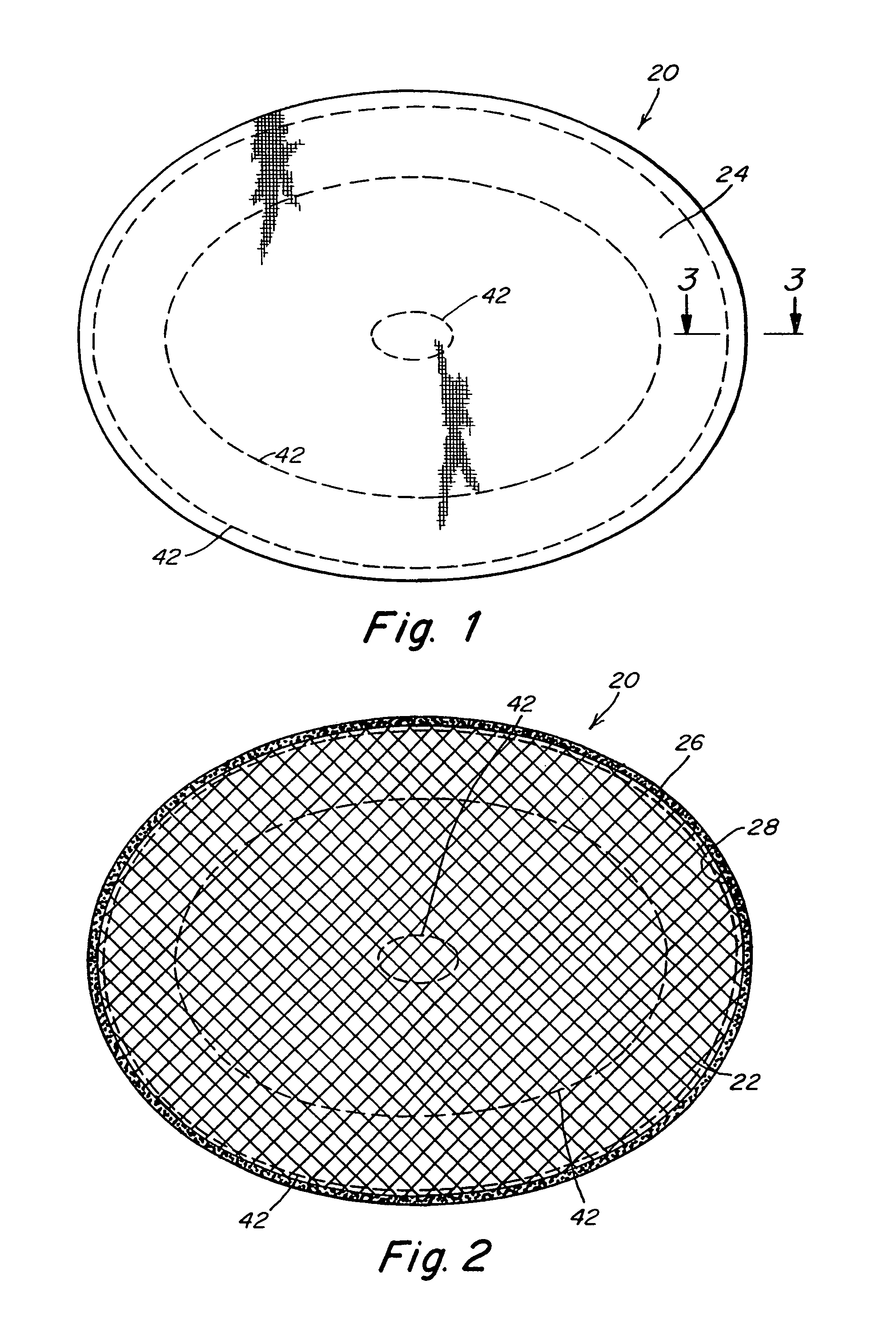 Implantable prosthesis