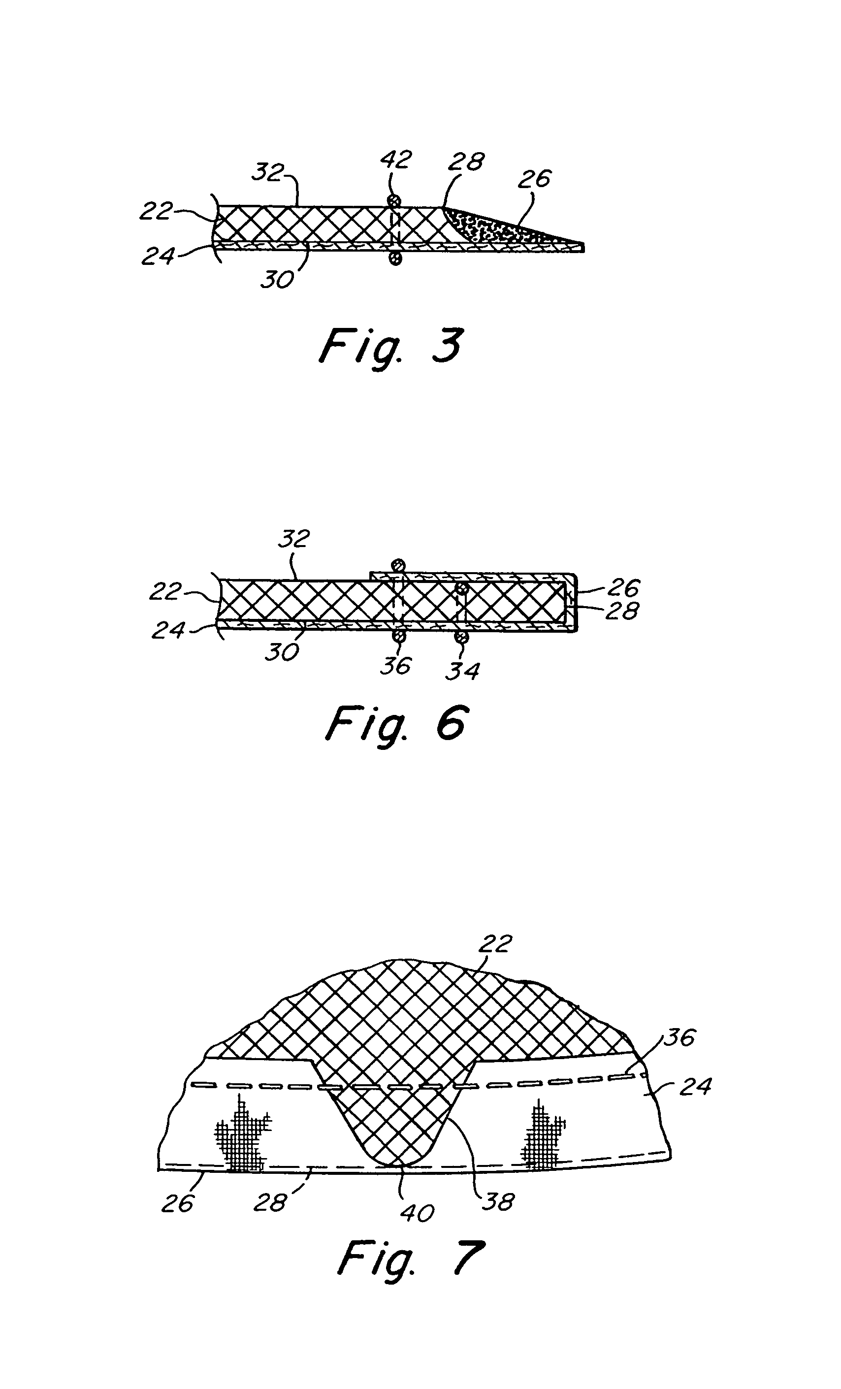 Implantable prosthesis