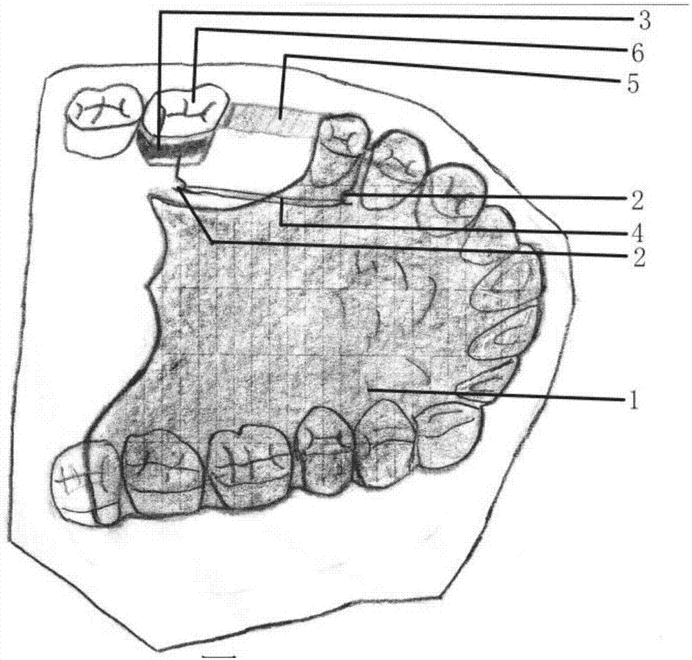 Movable correction appliance for integral mesial moving of molar tooth