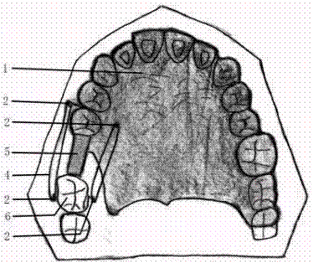 Movable correction appliance for integral mesial moving of molar tooth