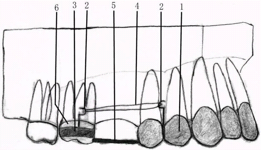 Movable correction appliance for integral mesial moving of molar tooth