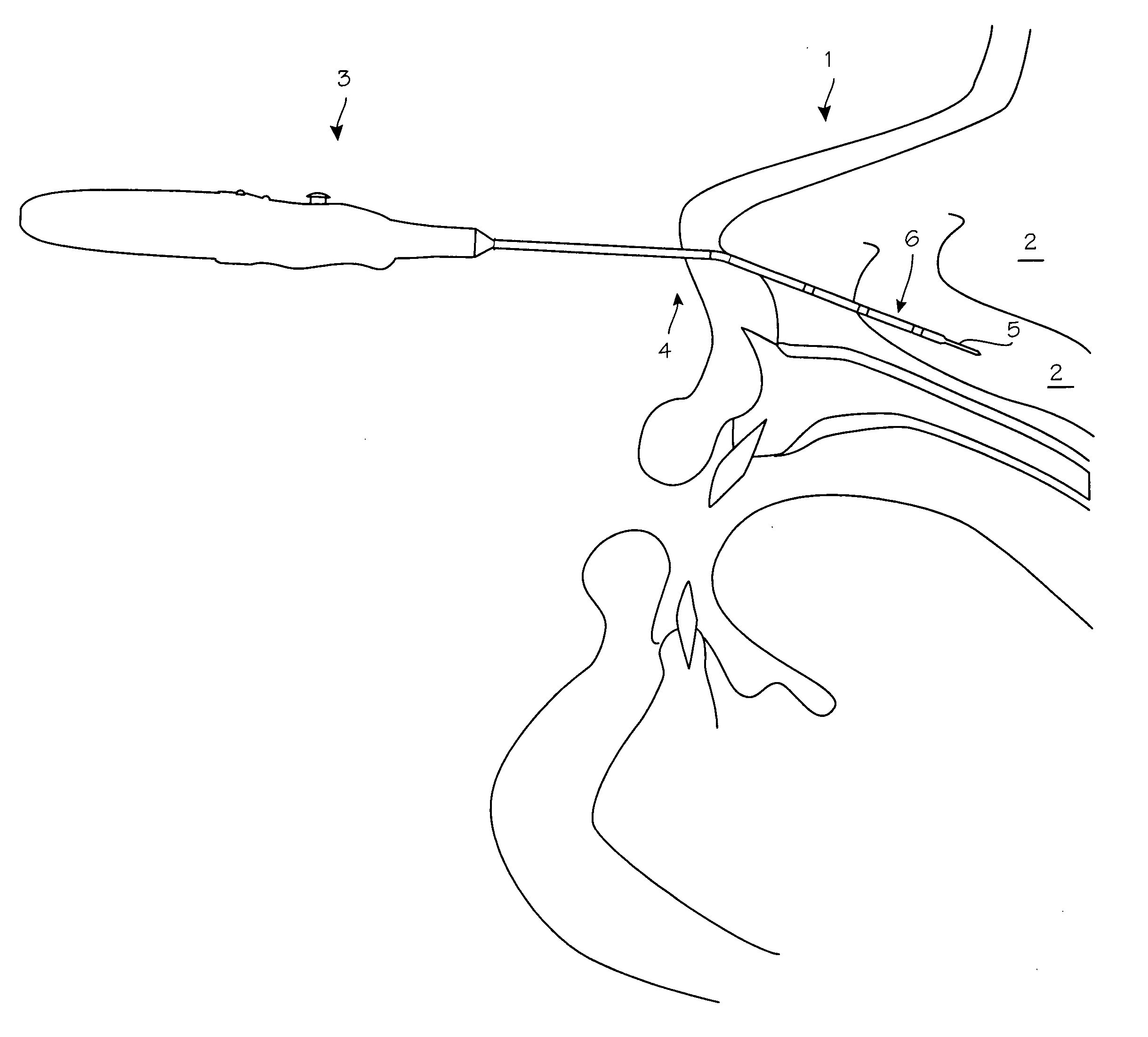 Resistive heating device and method for turbinate ablation