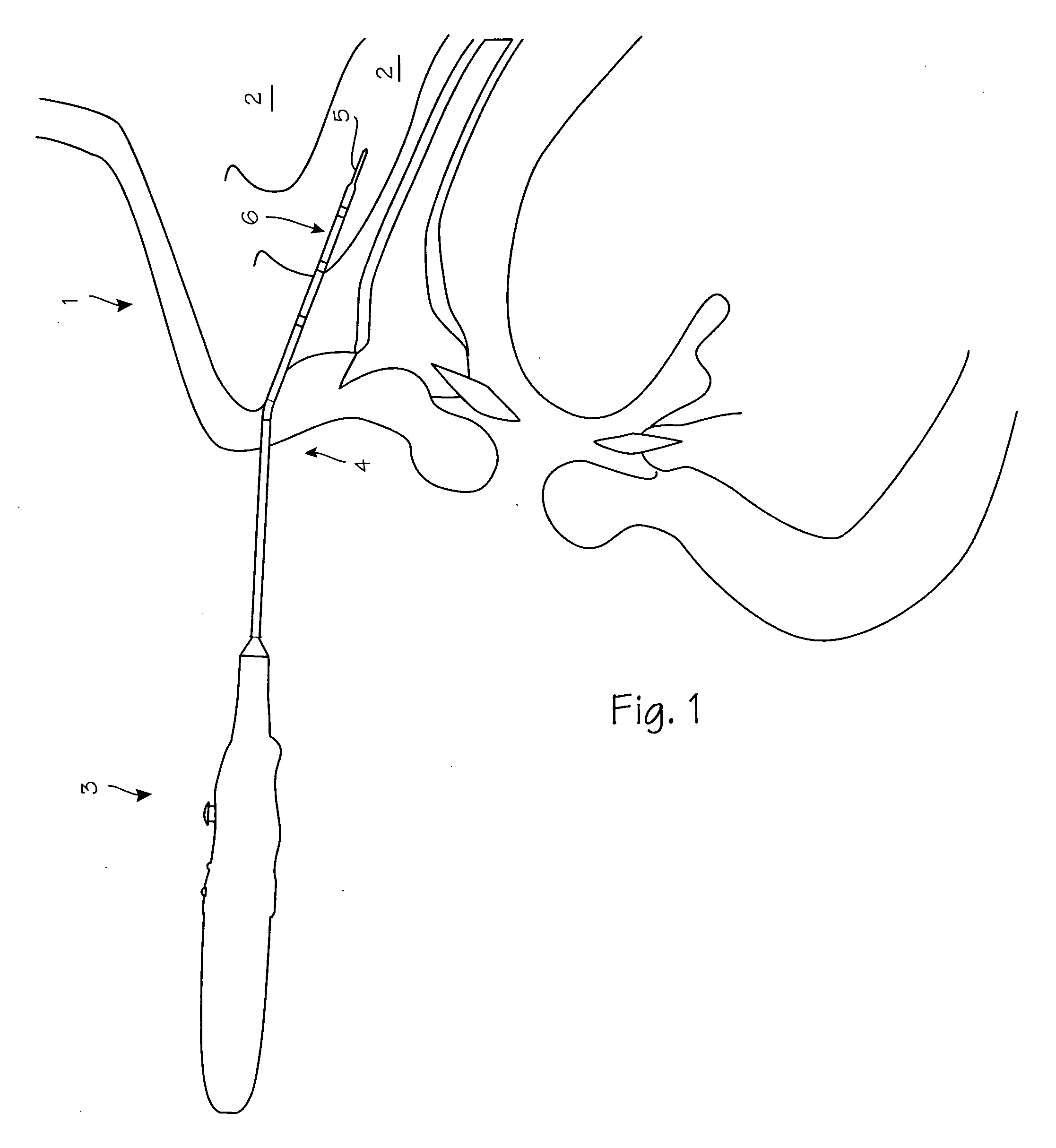 Resistive heating device and method for turbinate ablation