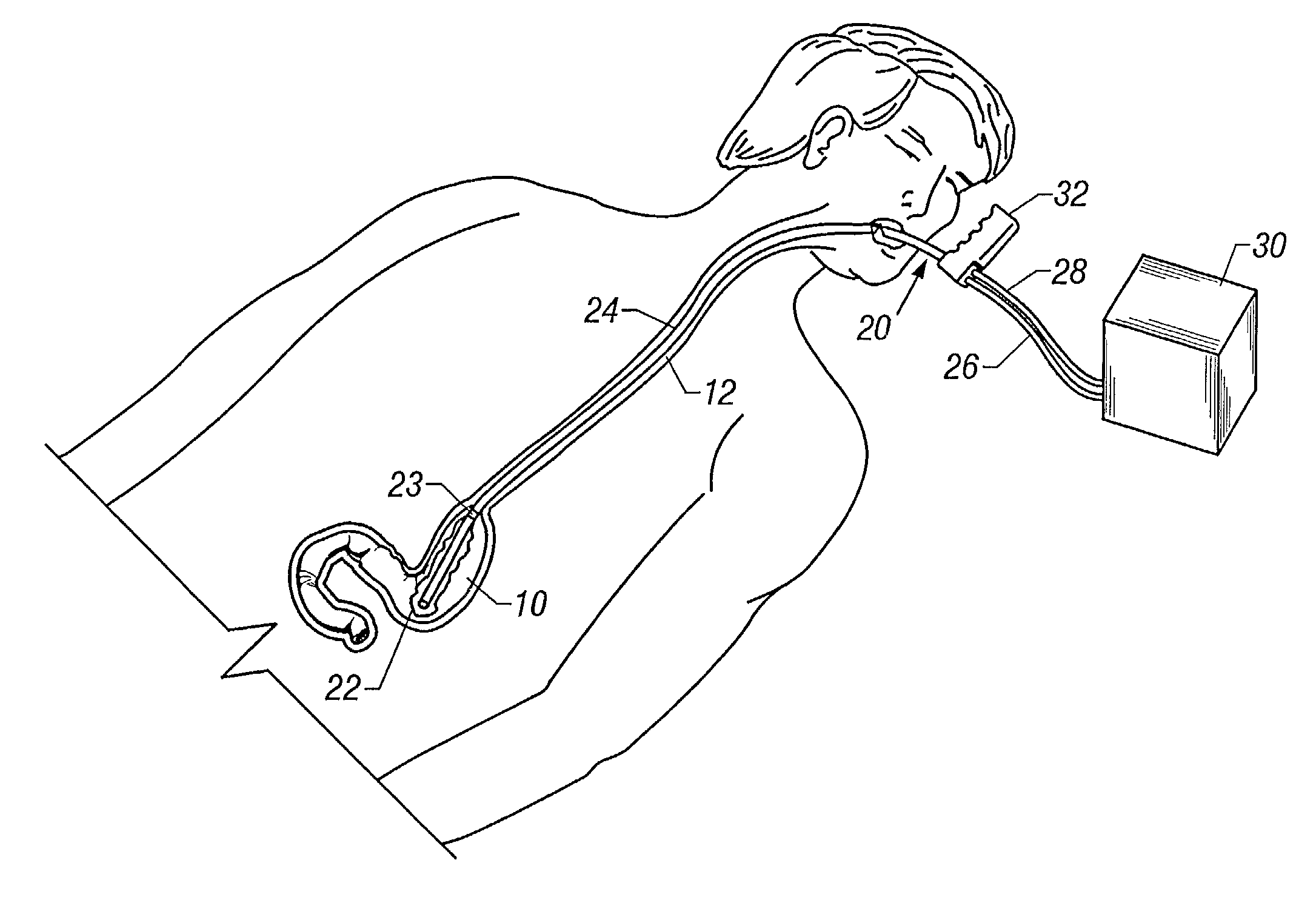 Method for gastric cooling using balloon catheter