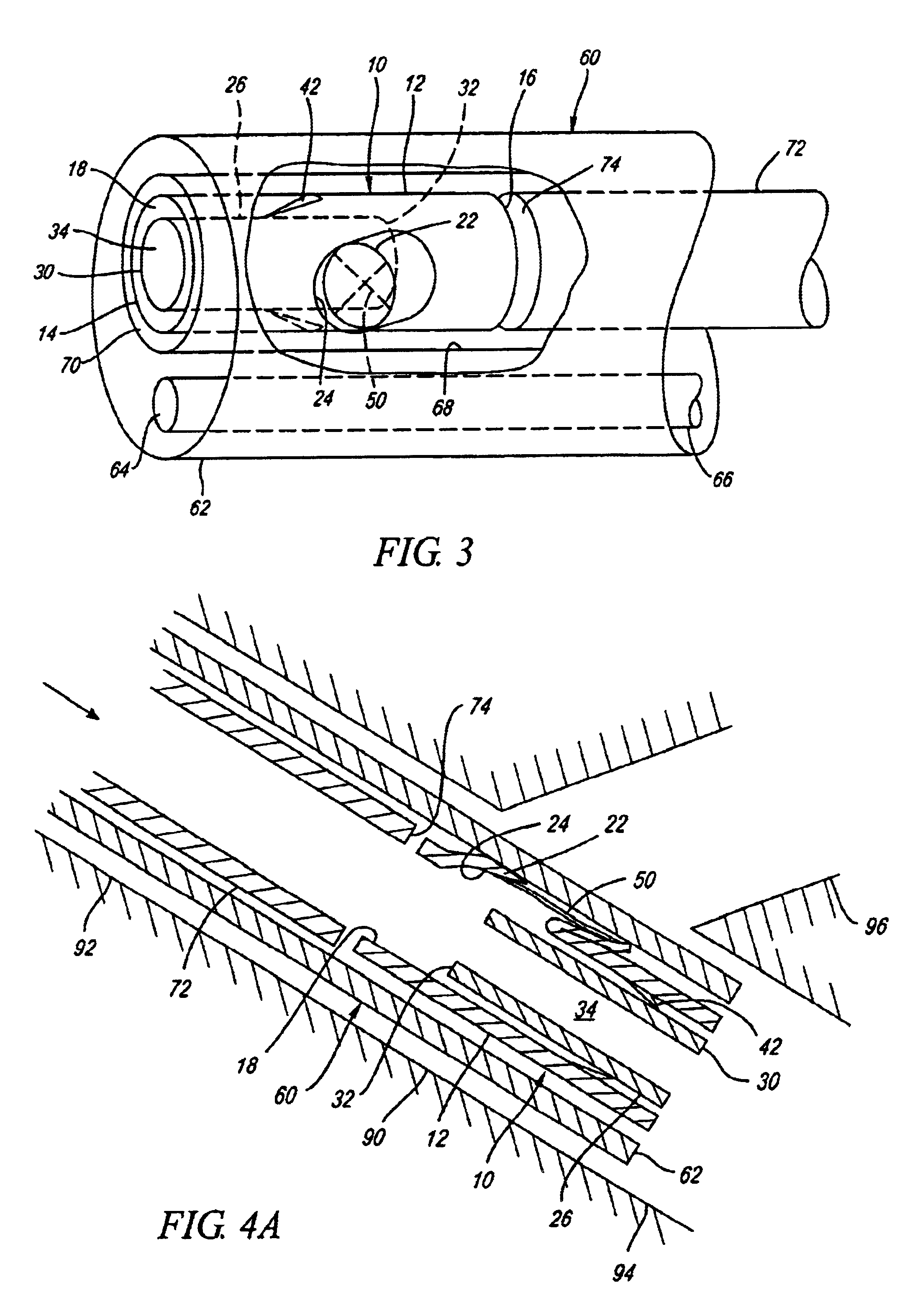 Lung assist apparatus and methods for use