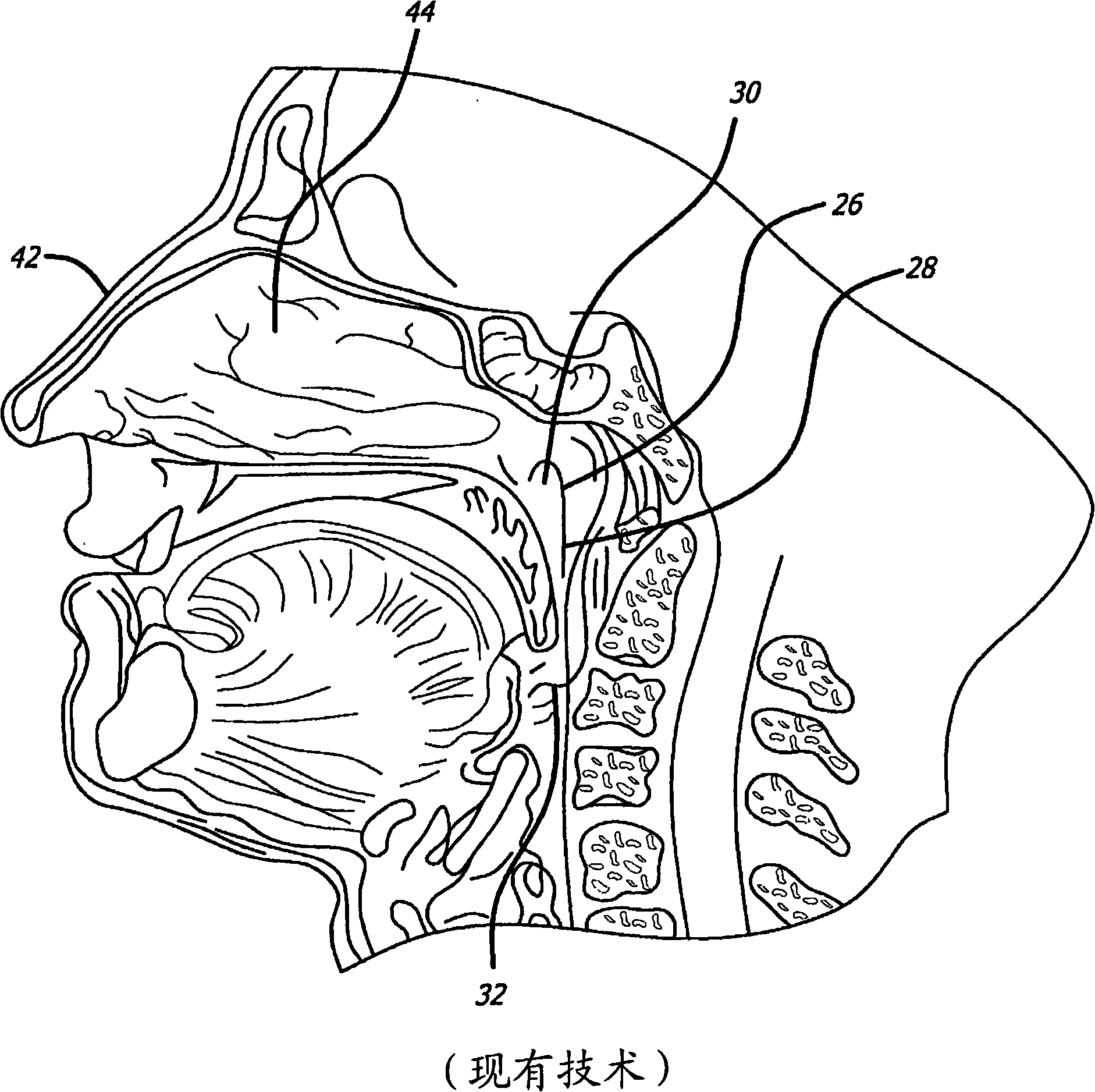 System for treating target tissue within the eustachian tube