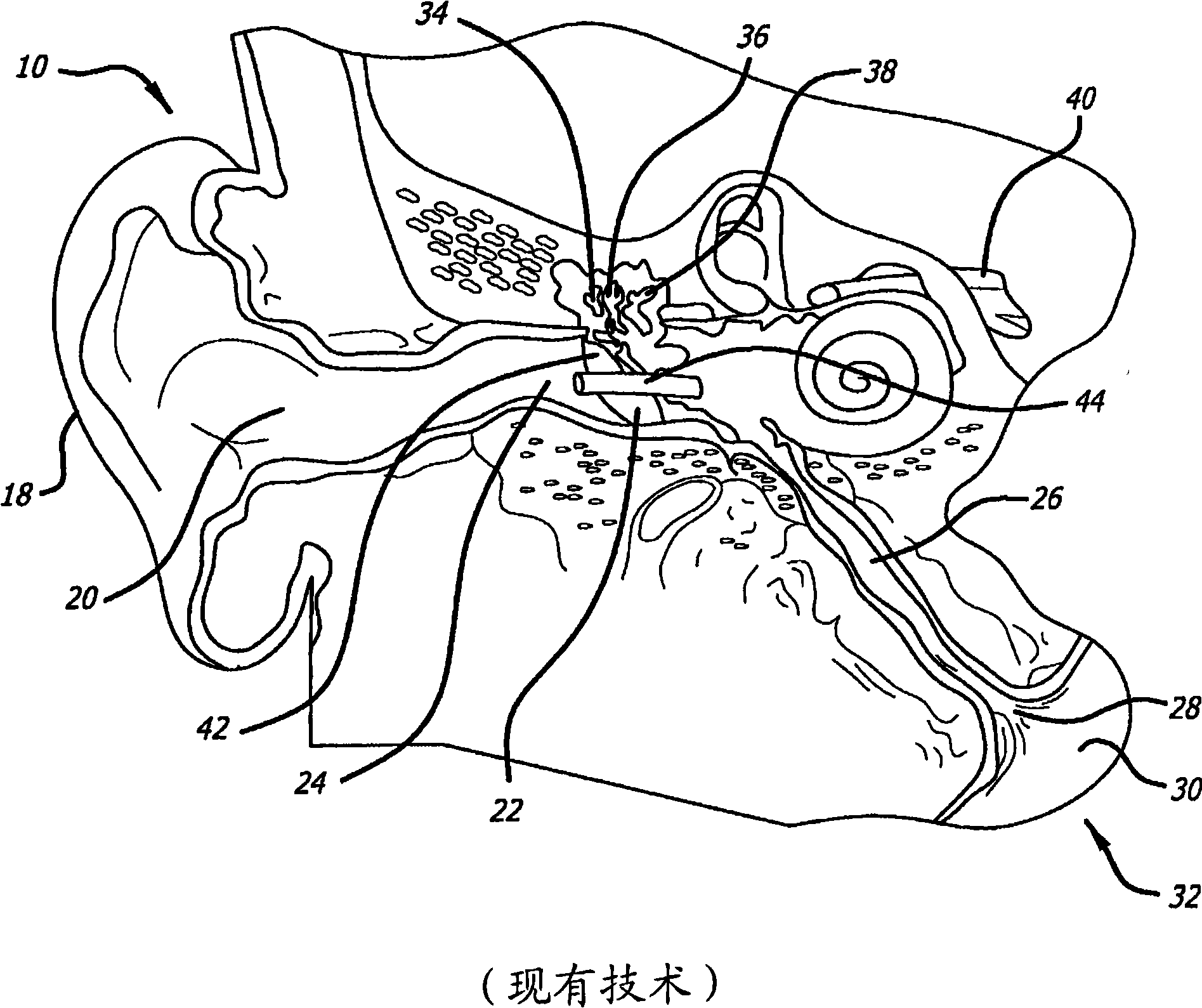 System for treating target tissue within the eustachian tube