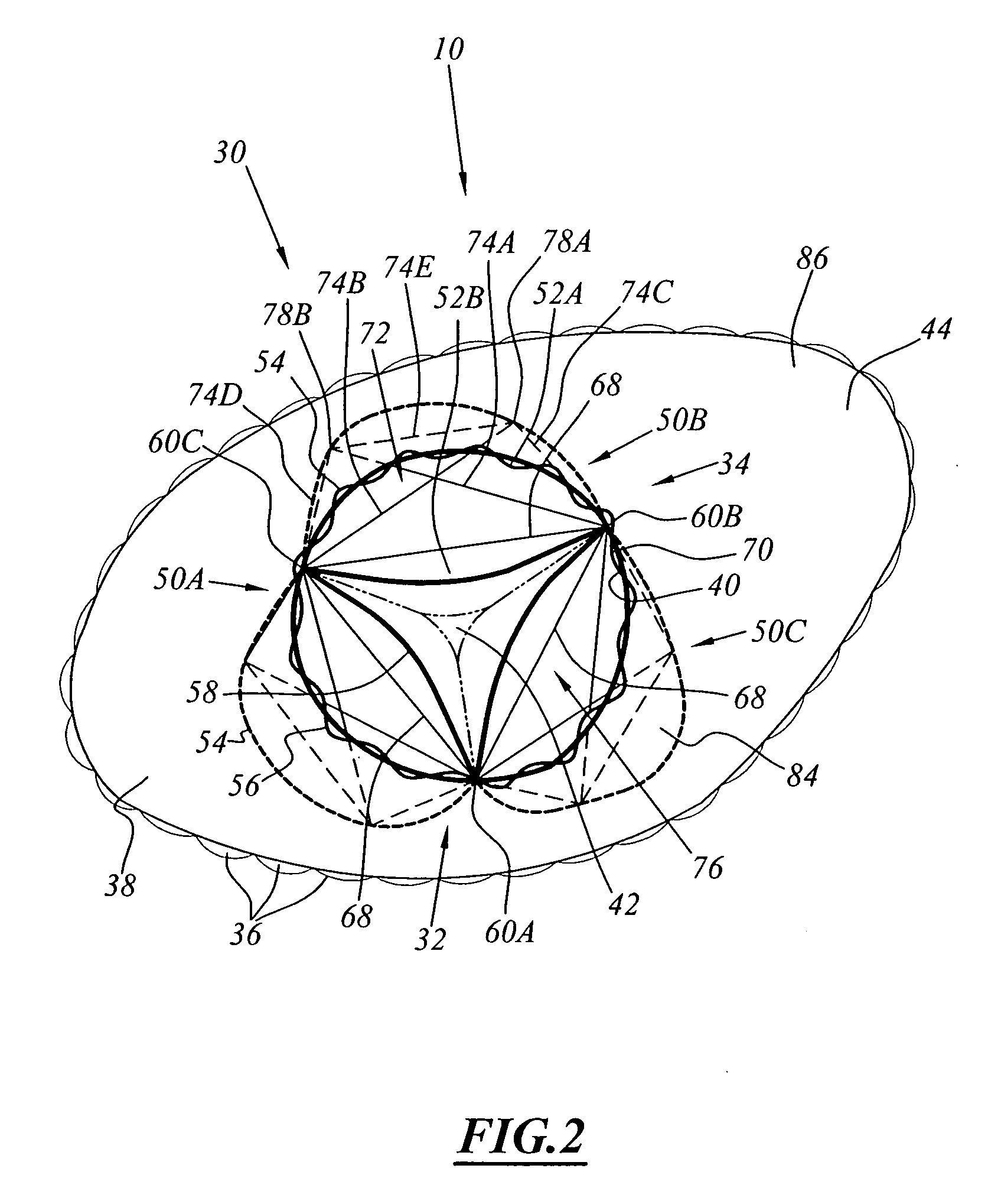 Implant for placing in a blood circulation conduit