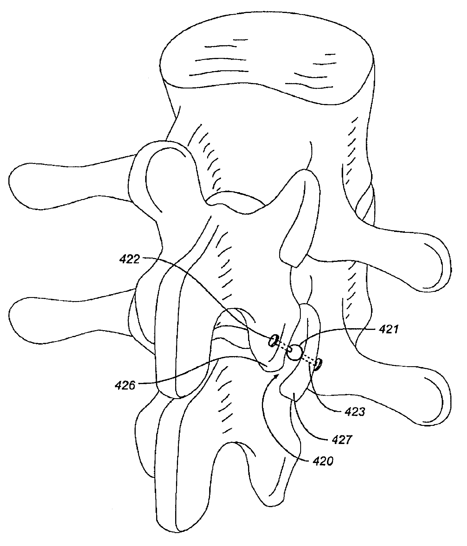 Facet device and method