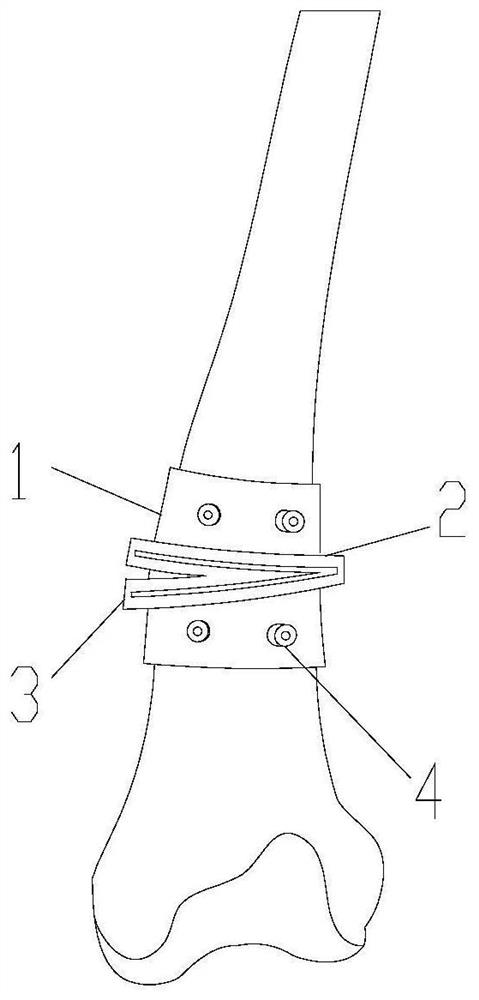 Knee joint introversion and extroversion osteotomy orthopedic guide plate and manufacturing method thereof