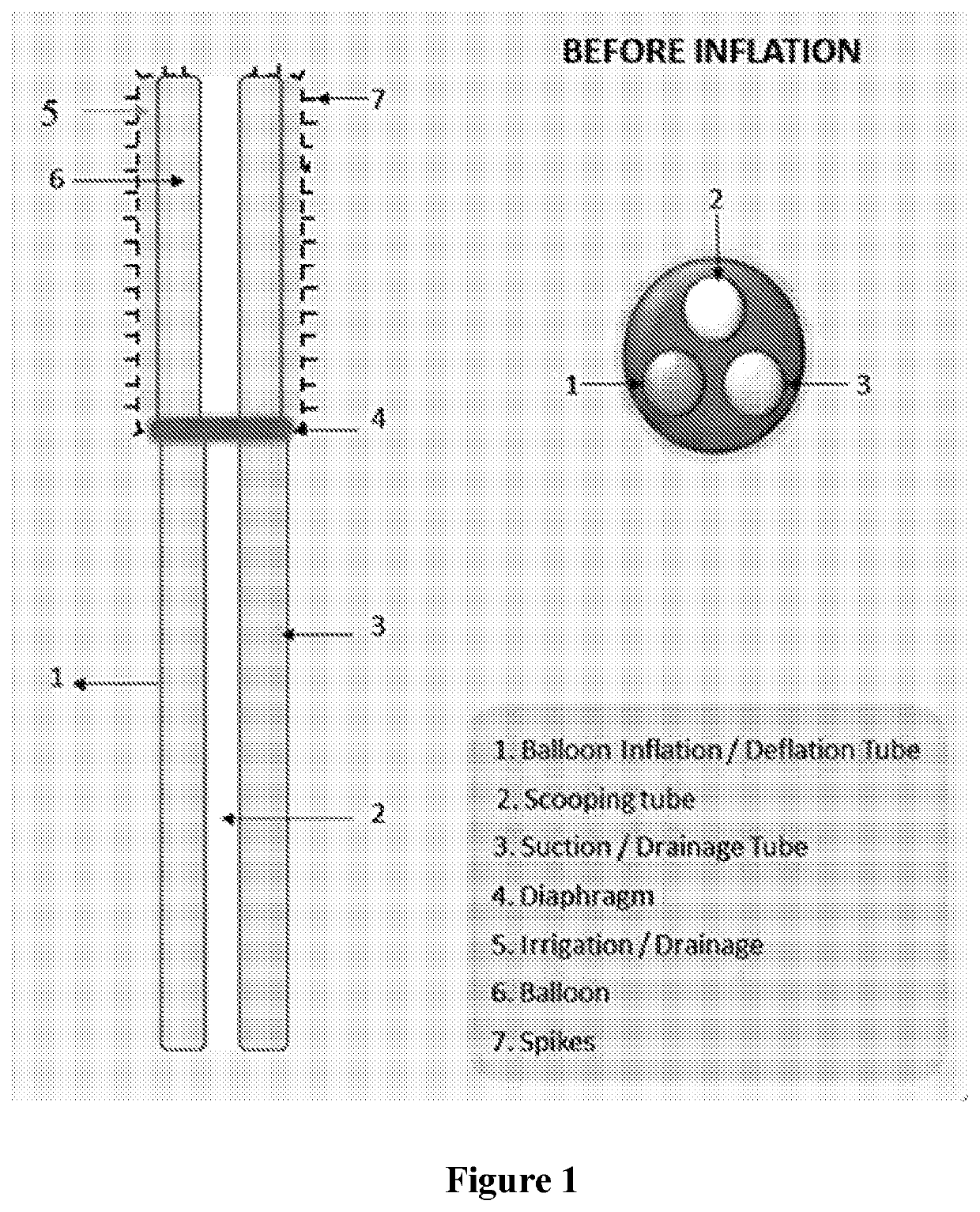 A device for the treatment of anal fistula-in-ano and complex fistula-in-ano