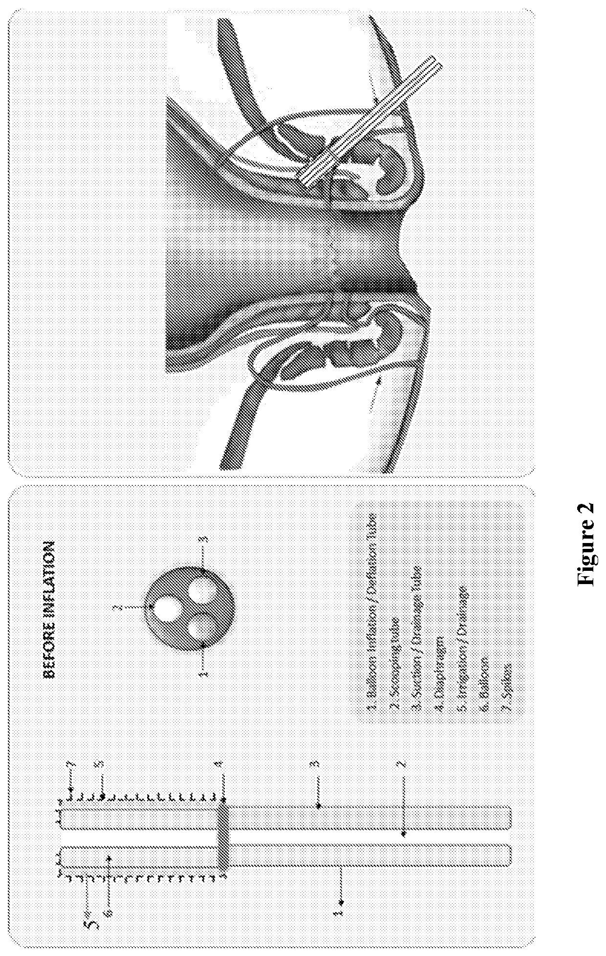 A device for the treatment of anal fistula-in-ano and complex fistula-in-ano