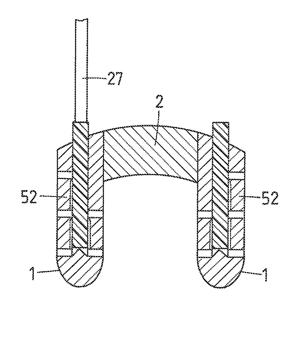 Method and implant for stabilizing two bone portions separated by a cut or fracture