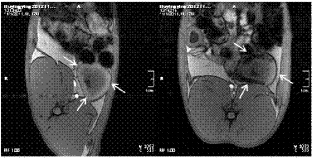 Magnetic resonance imaging detectable in-situ liquid crystal precursor embolism composition, preparation and application thereof